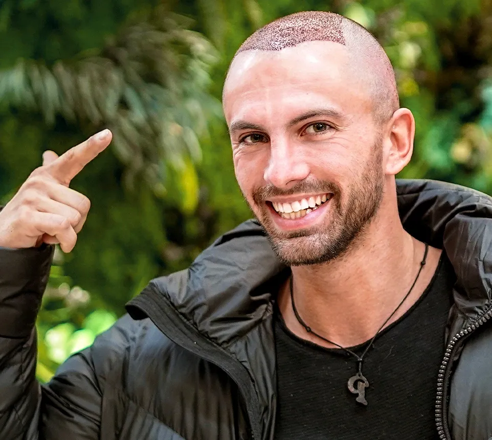 Hair Transplant Turkey: Shedding Phase