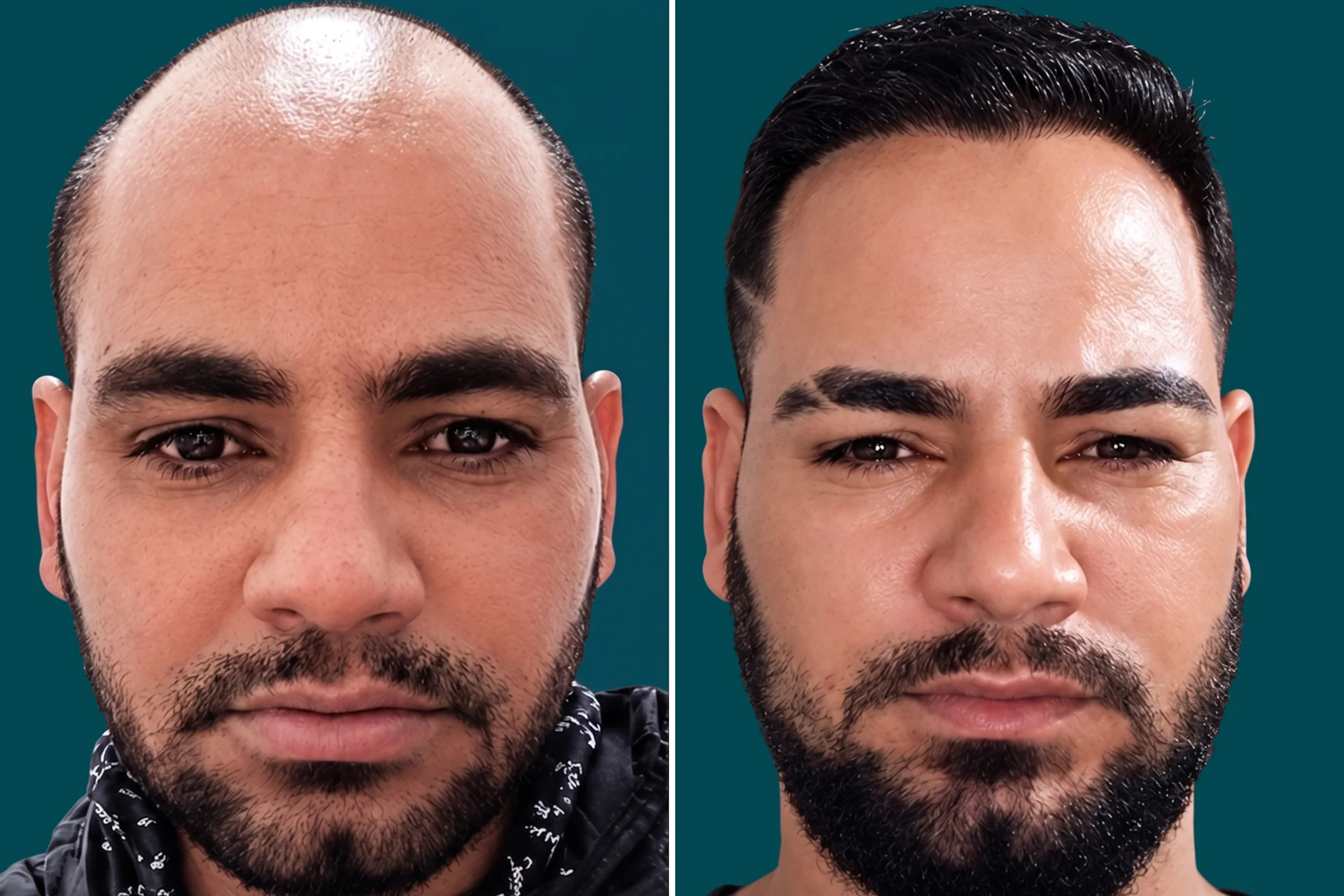 Hair Mesotherapy 1