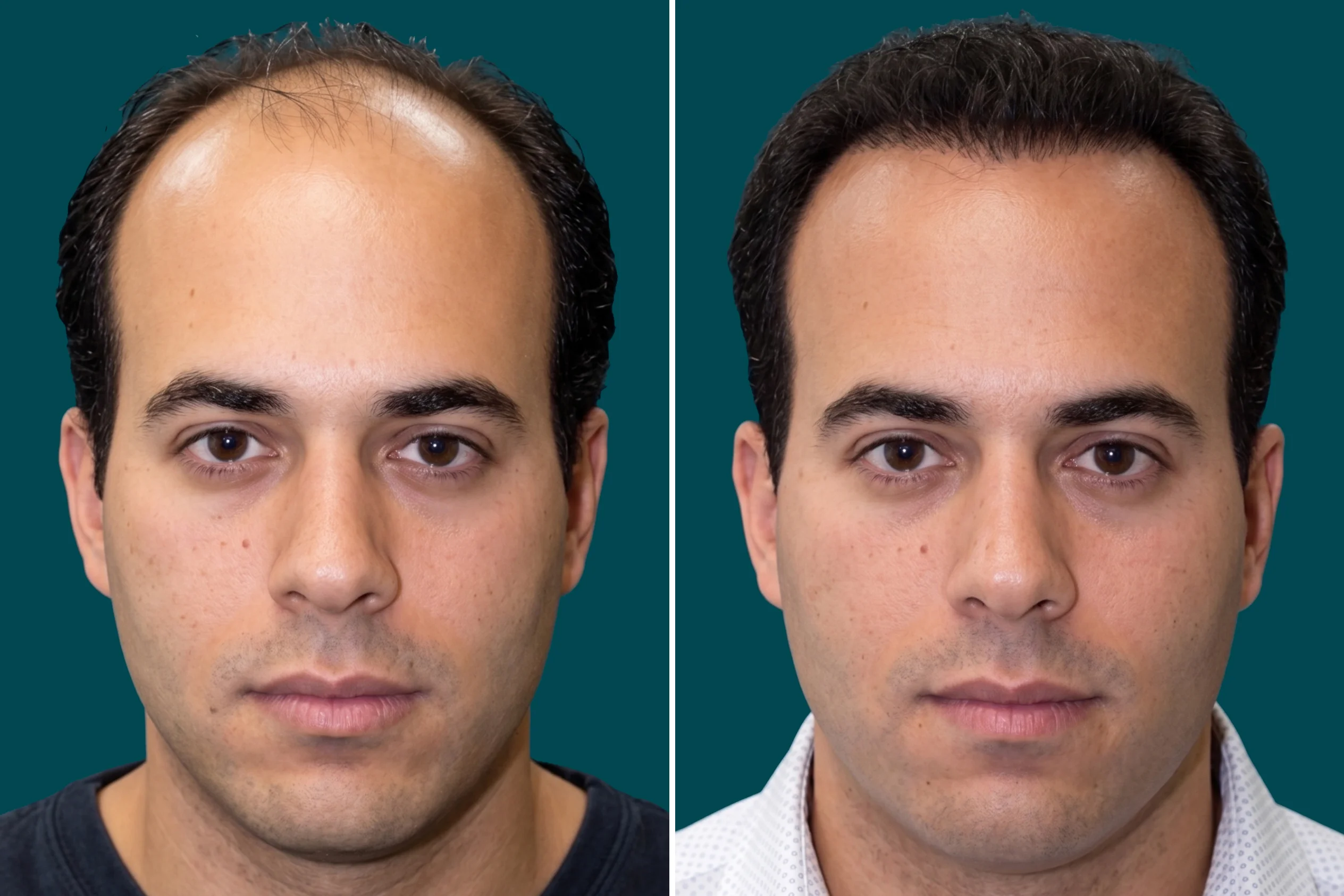 Hair Mesotherapy 2