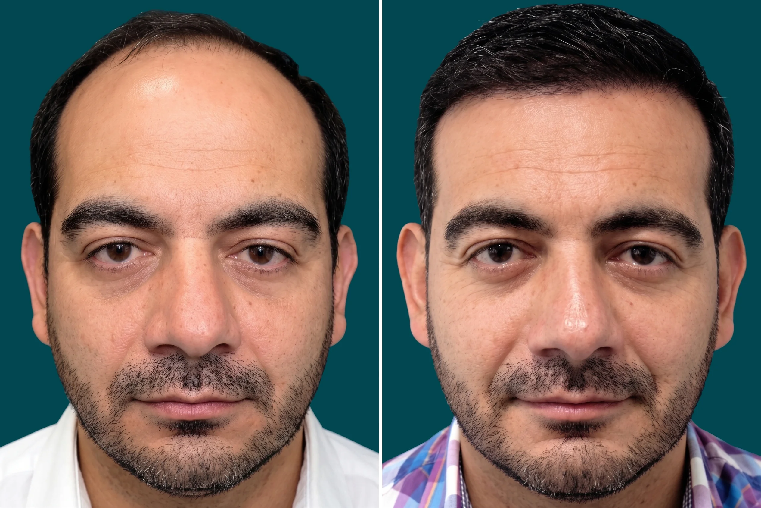 Hair Mesotherapy 3