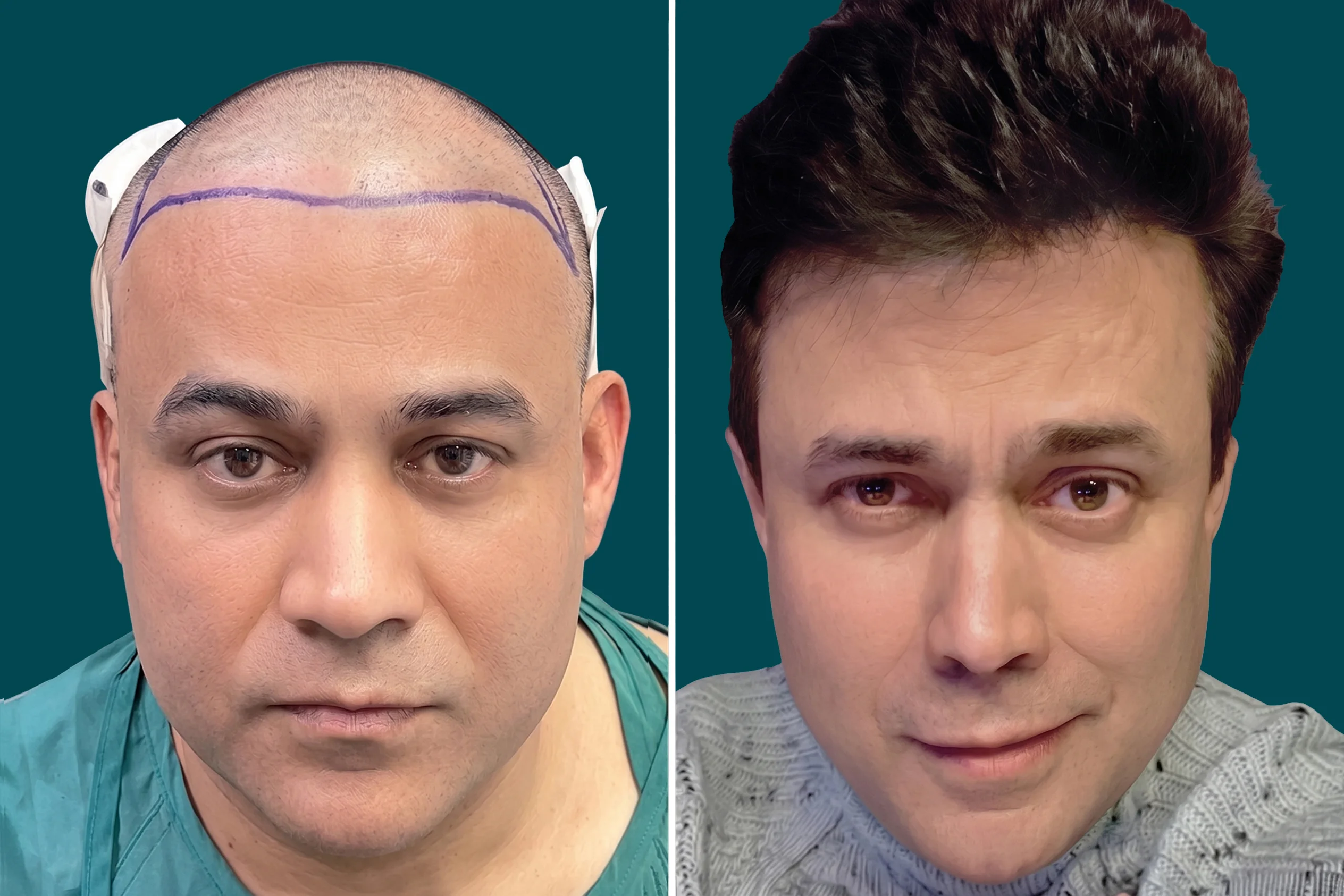 Hair-Treatments-Hair Transplant 8
