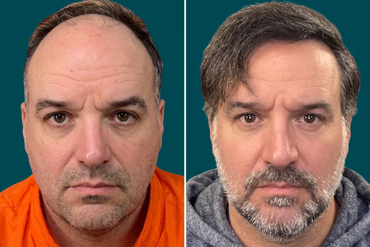 Hair-Treatments-Hair Transplant 6