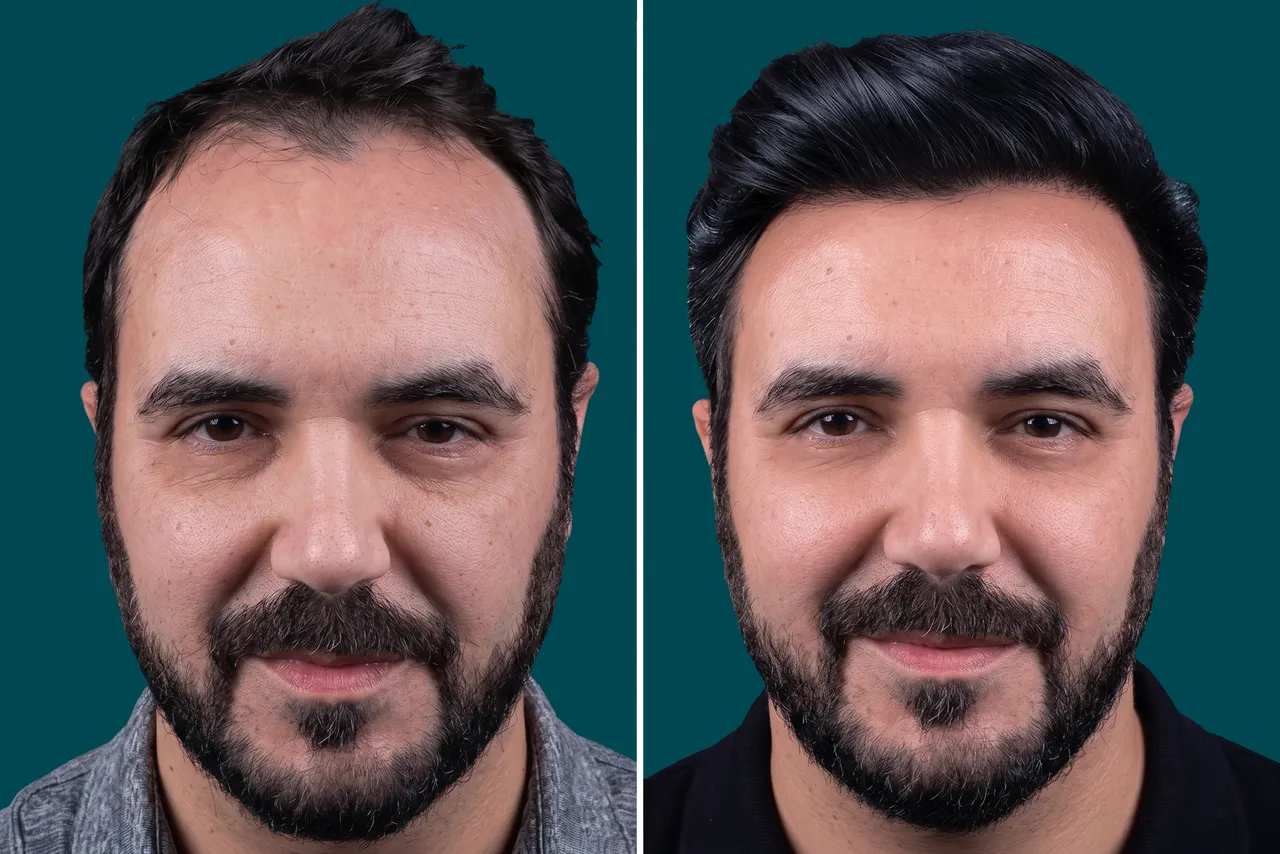 Hair-Transplant-Unshaven Hair Transplant 1