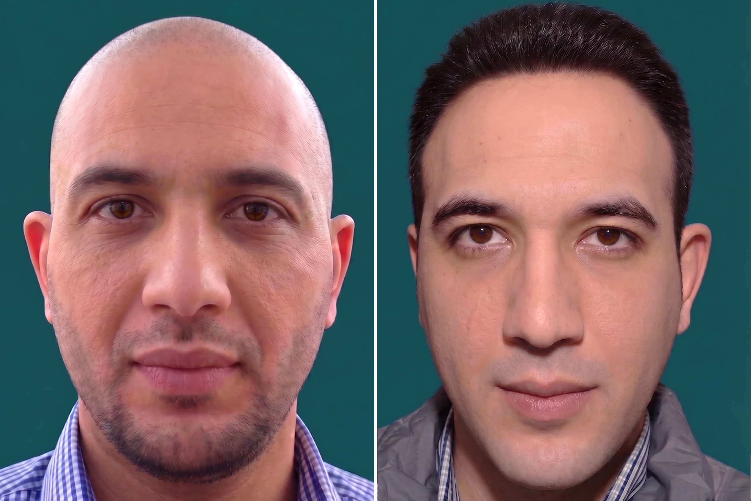 Hair-Transplant-FUT Hair Transplant 5