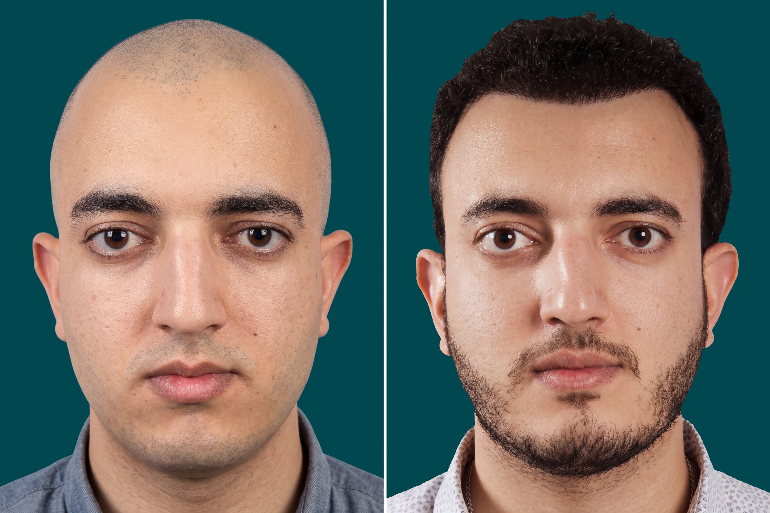 Hair-Transplant-Fue Hair Transplant 2