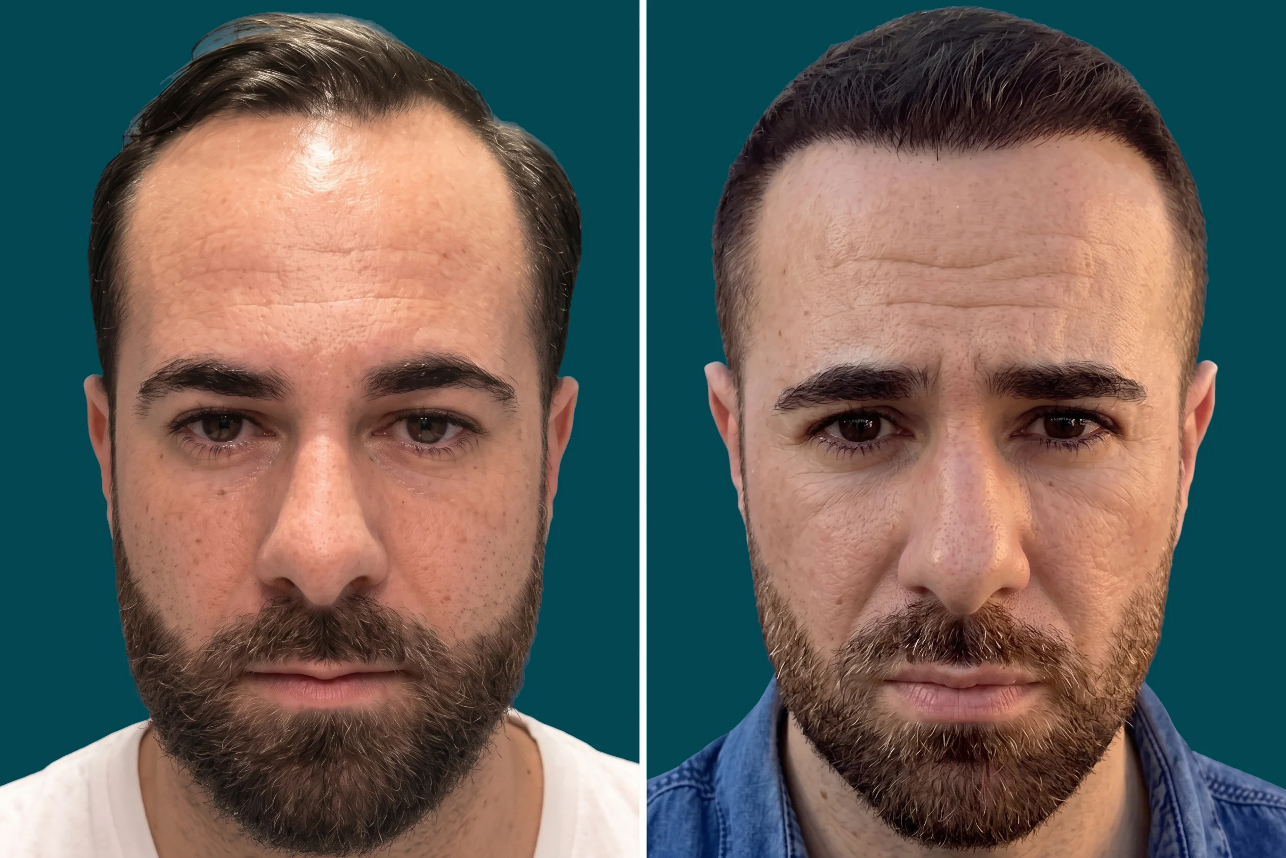 Hair-Transplant-Hybrid Hair Transplant 5
