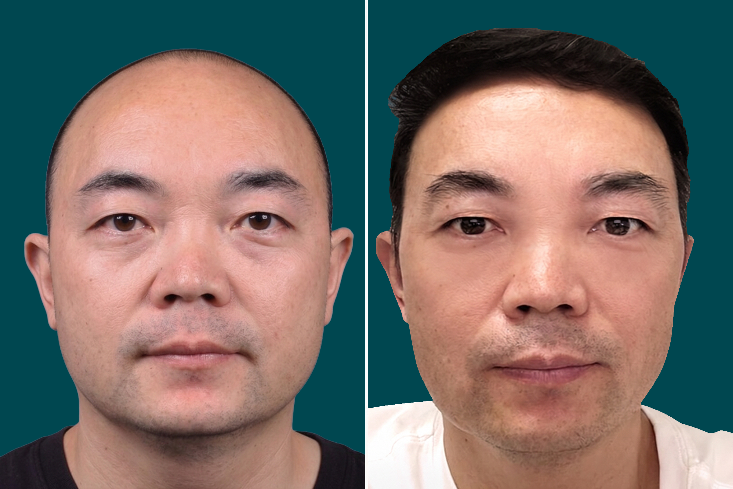 Hair-Transplant-Fue Hair Transplant 4