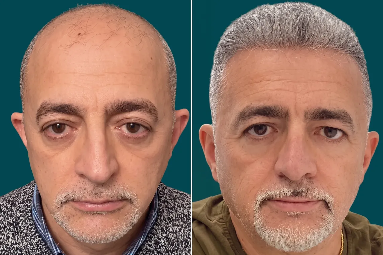 Hair-Transplant-Hybrid Hair Transplant 6