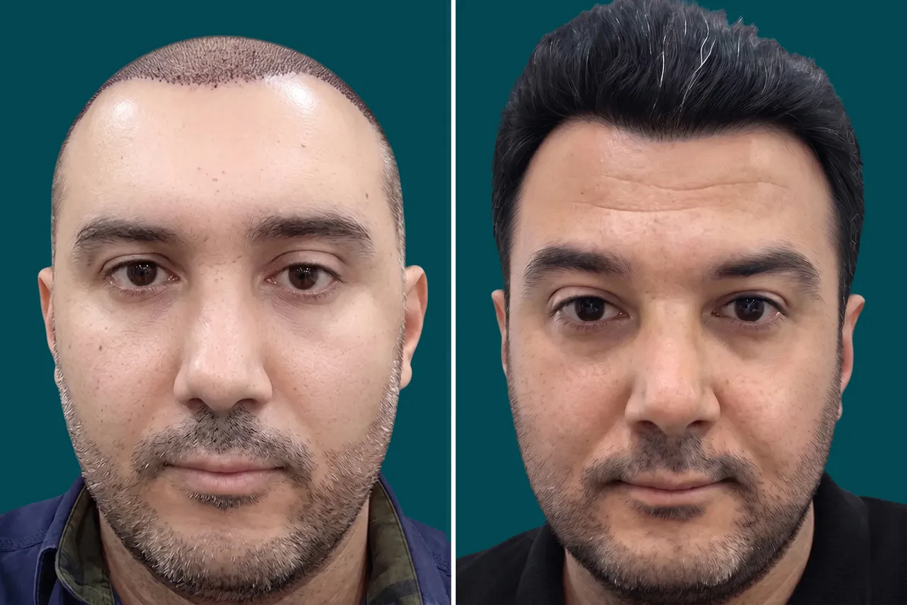 Hair-Transplant-Unshaven Hair Transplant 2