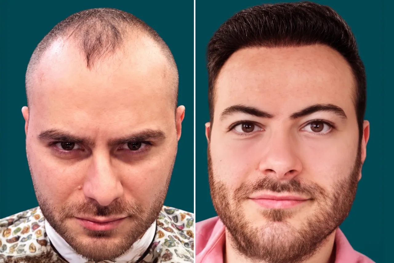 Hair-Treatments-Hair Transplant 13