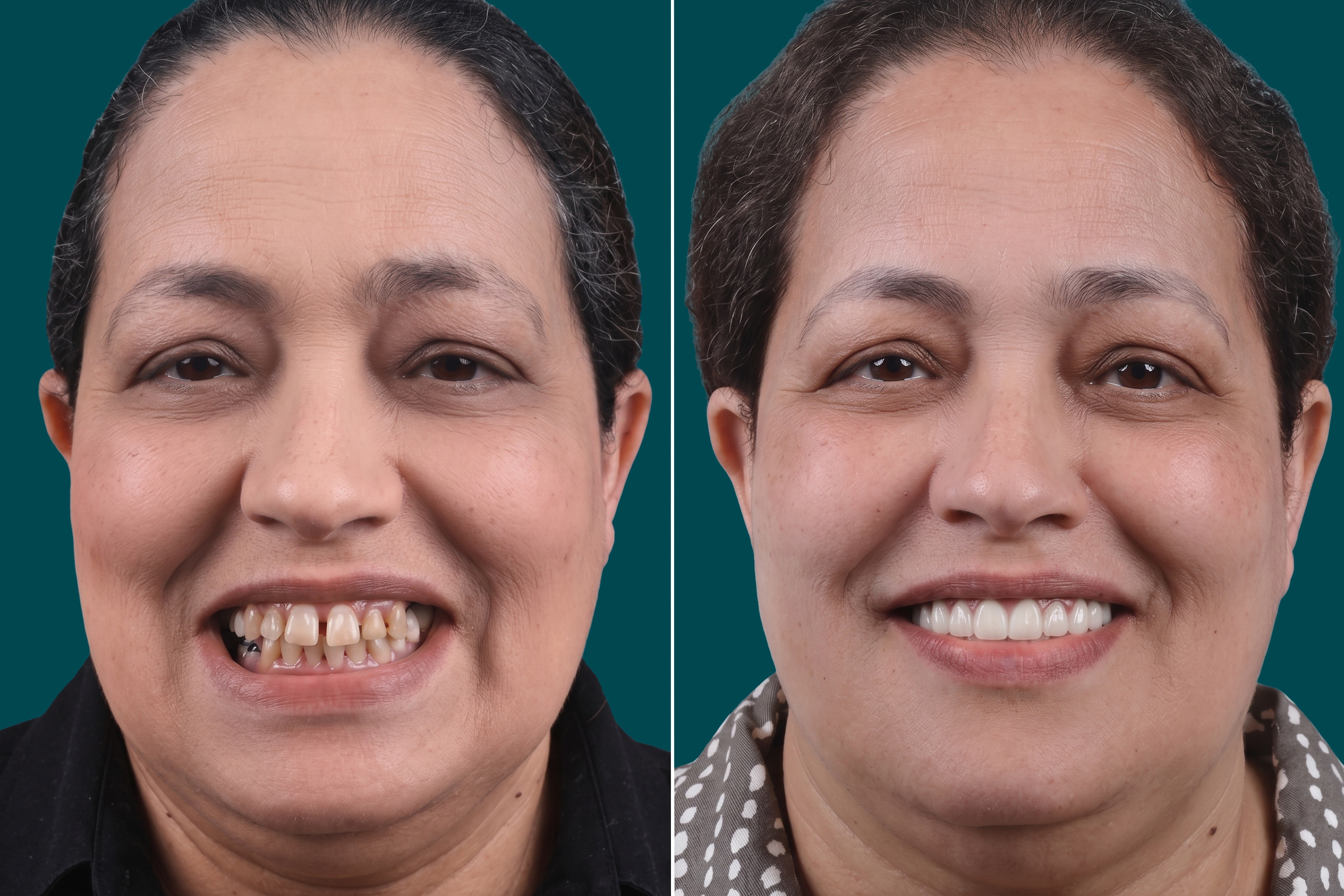 Smile-Makeover-Hollywood Smile 1