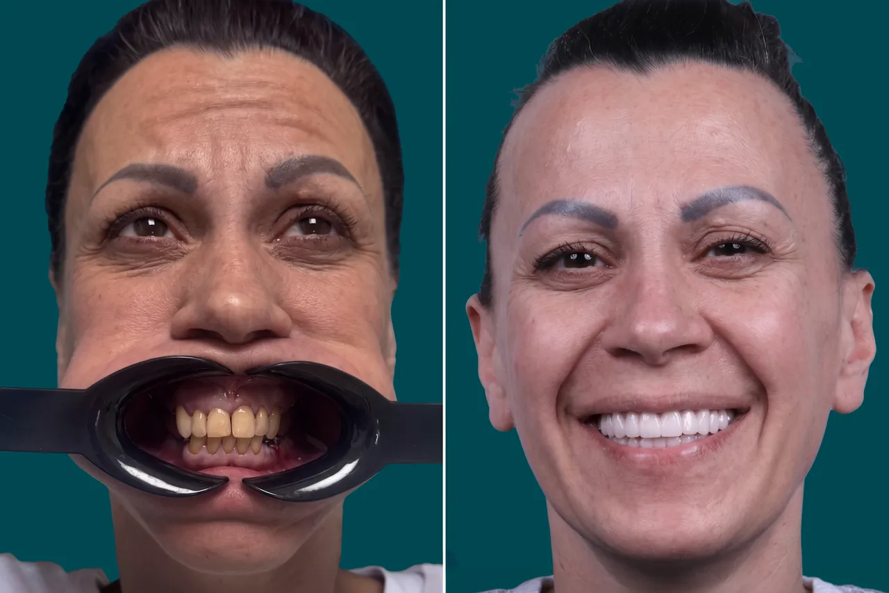 Smile Makeover-Hollywood-Smile 2