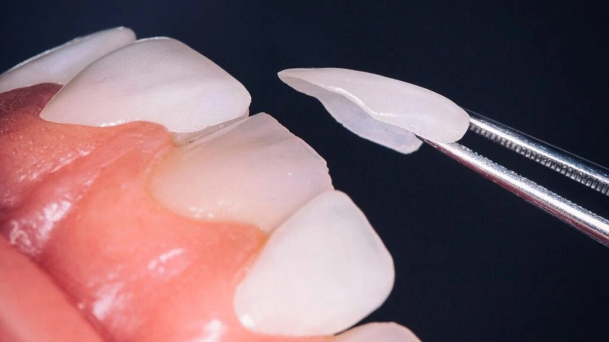 Laminate-Veneers