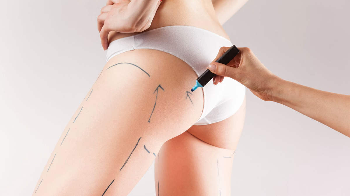 Leg Liposuction in turkey