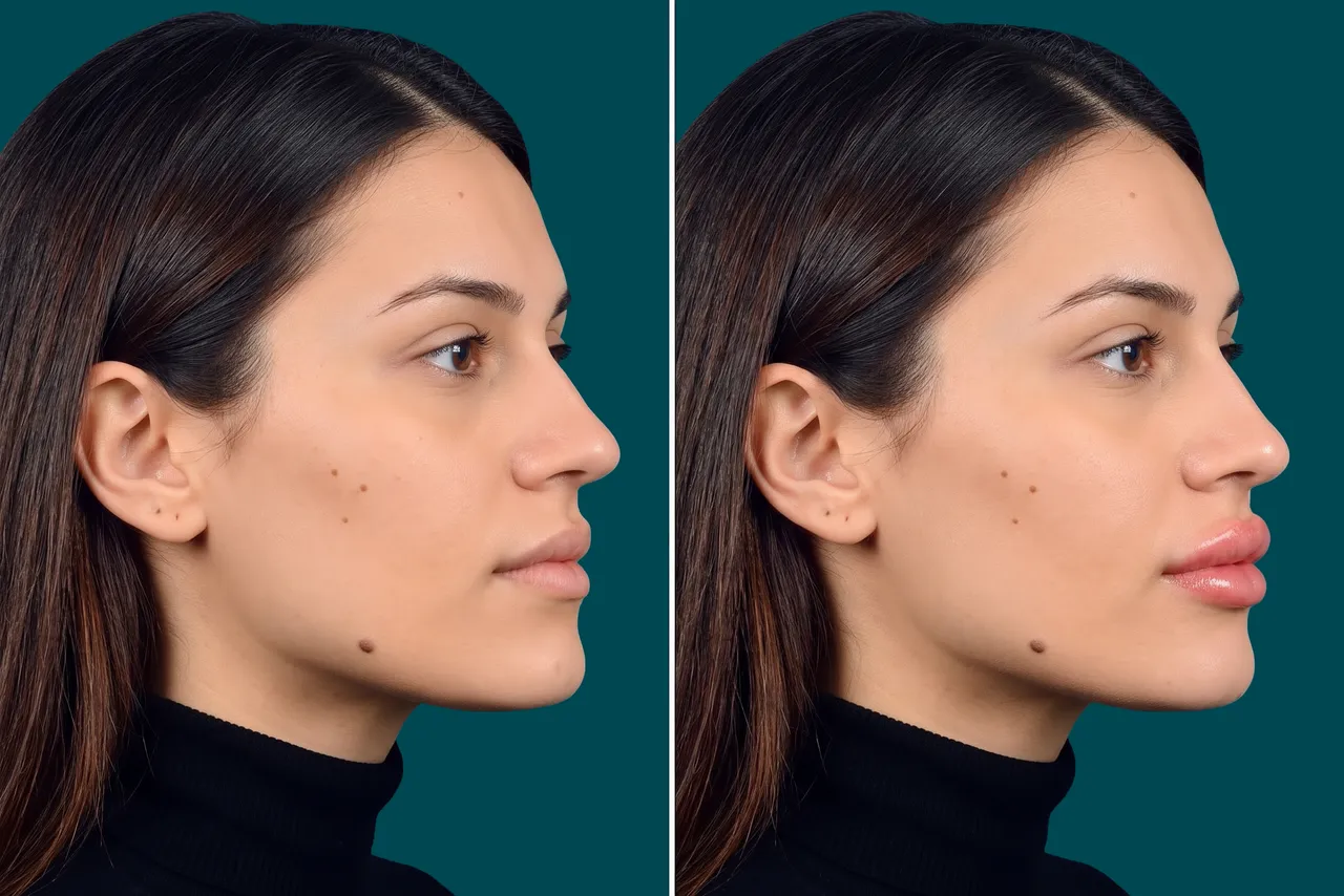 Lip Lift Before and After 2