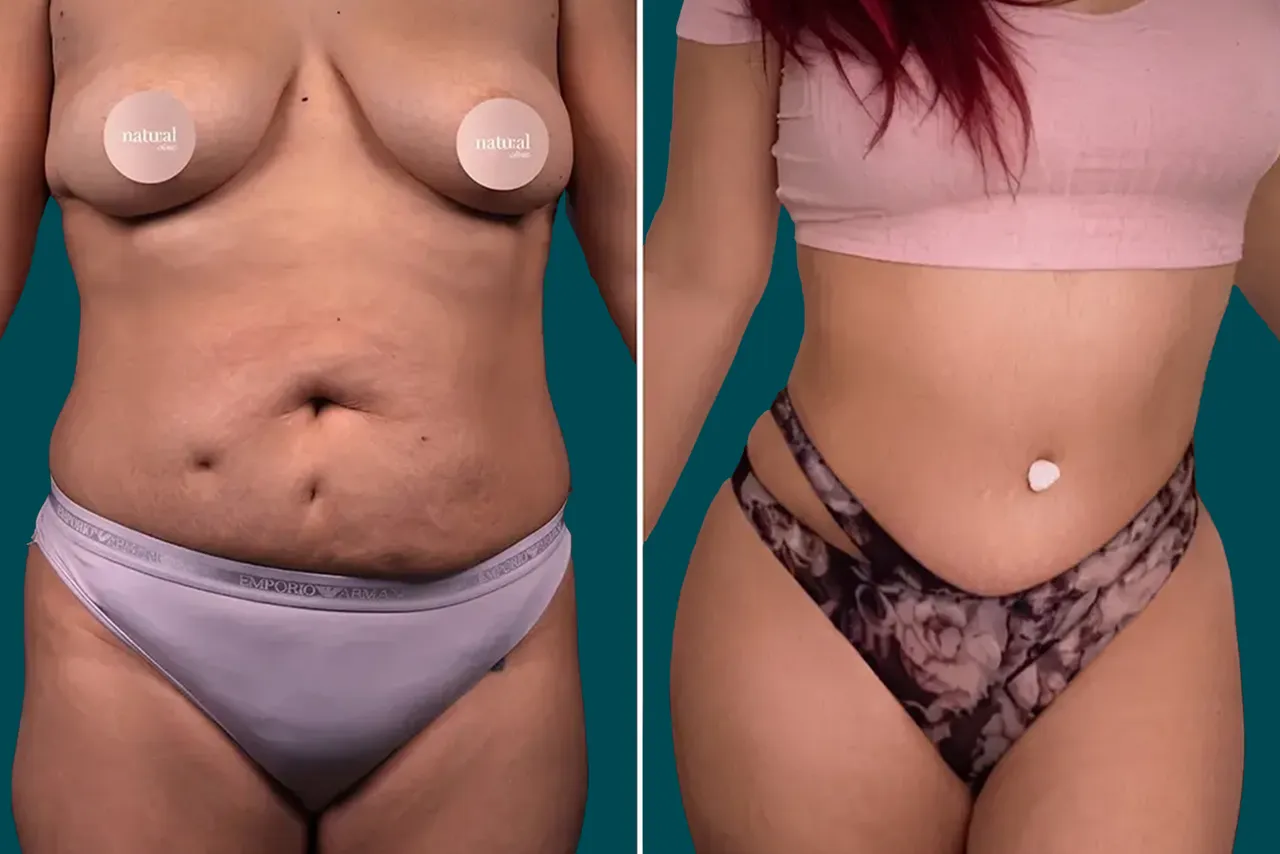 Liposuction Before and After 1