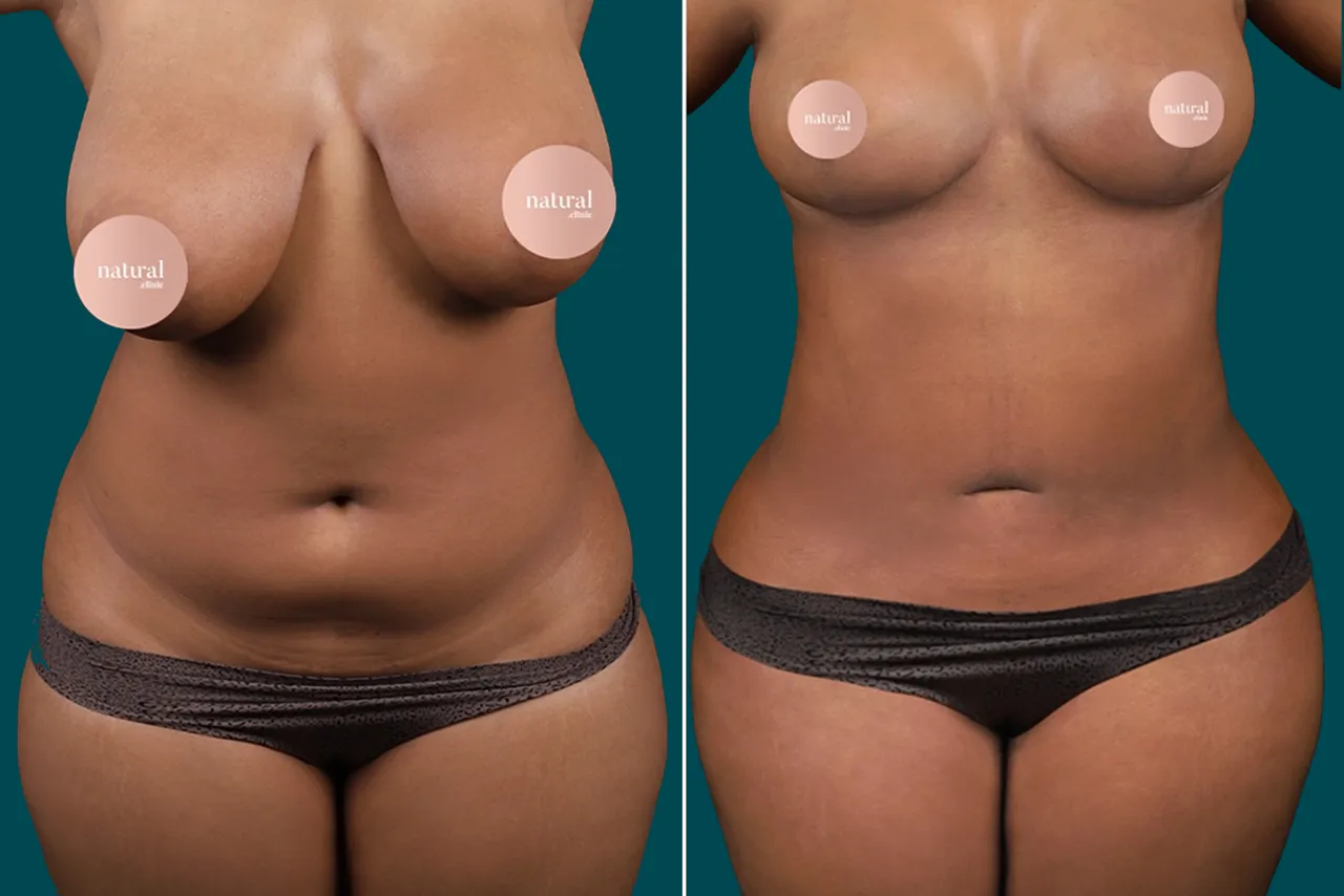 Liposuction Before and After 10