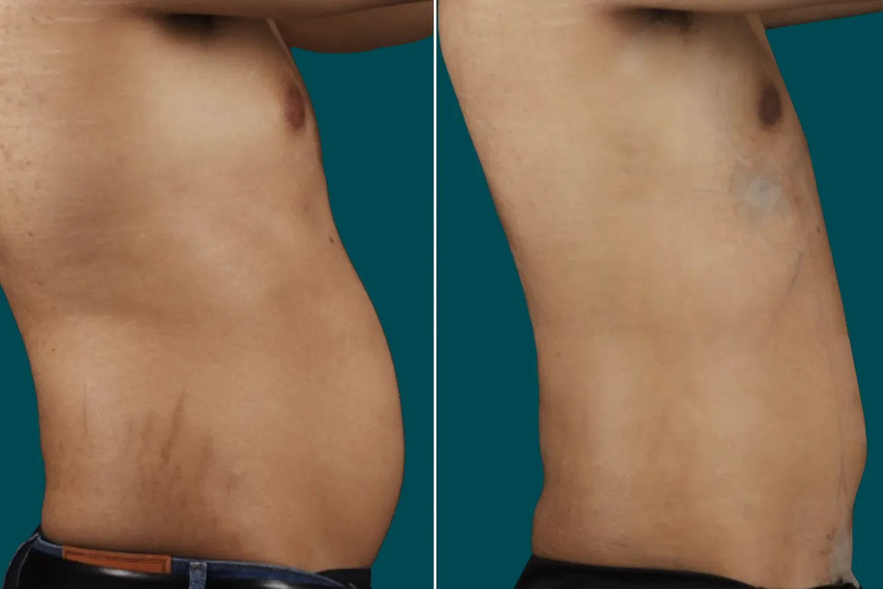 Liposuction Before and After 11