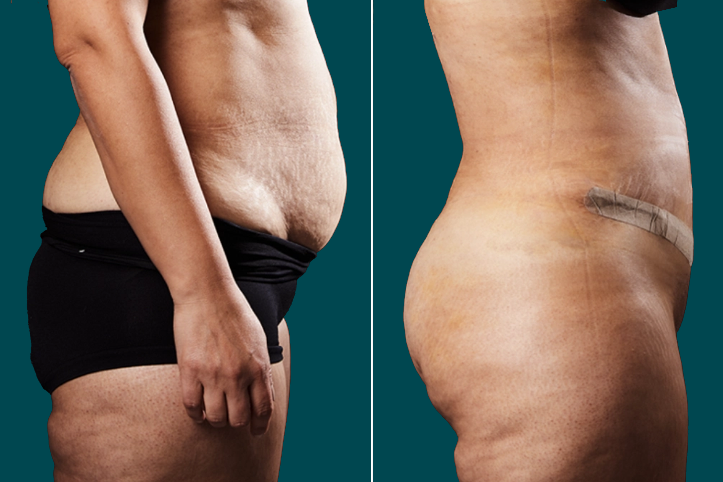 Liposuction Before and After 12