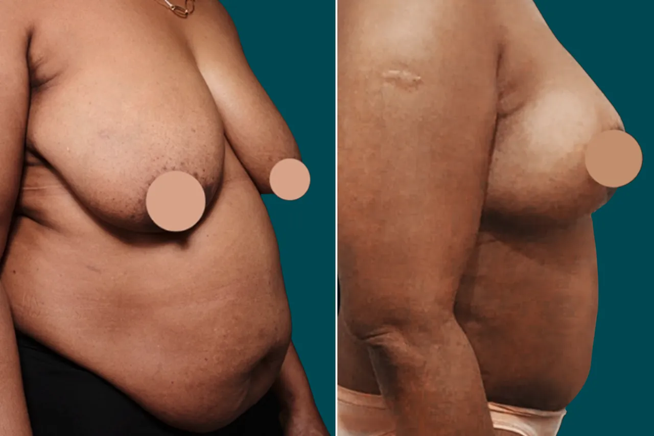 Liposuction Before and After 13