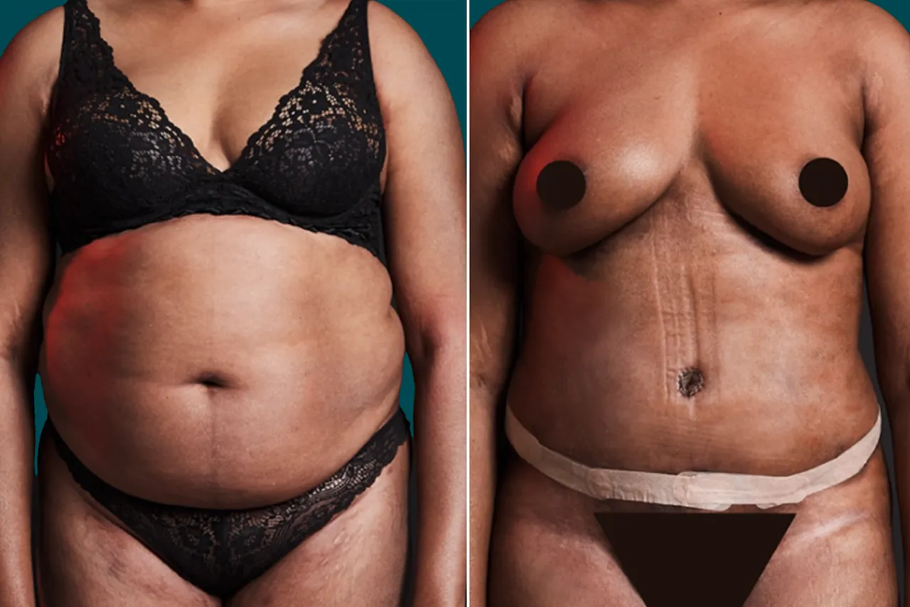 Liposuction Before and After 14