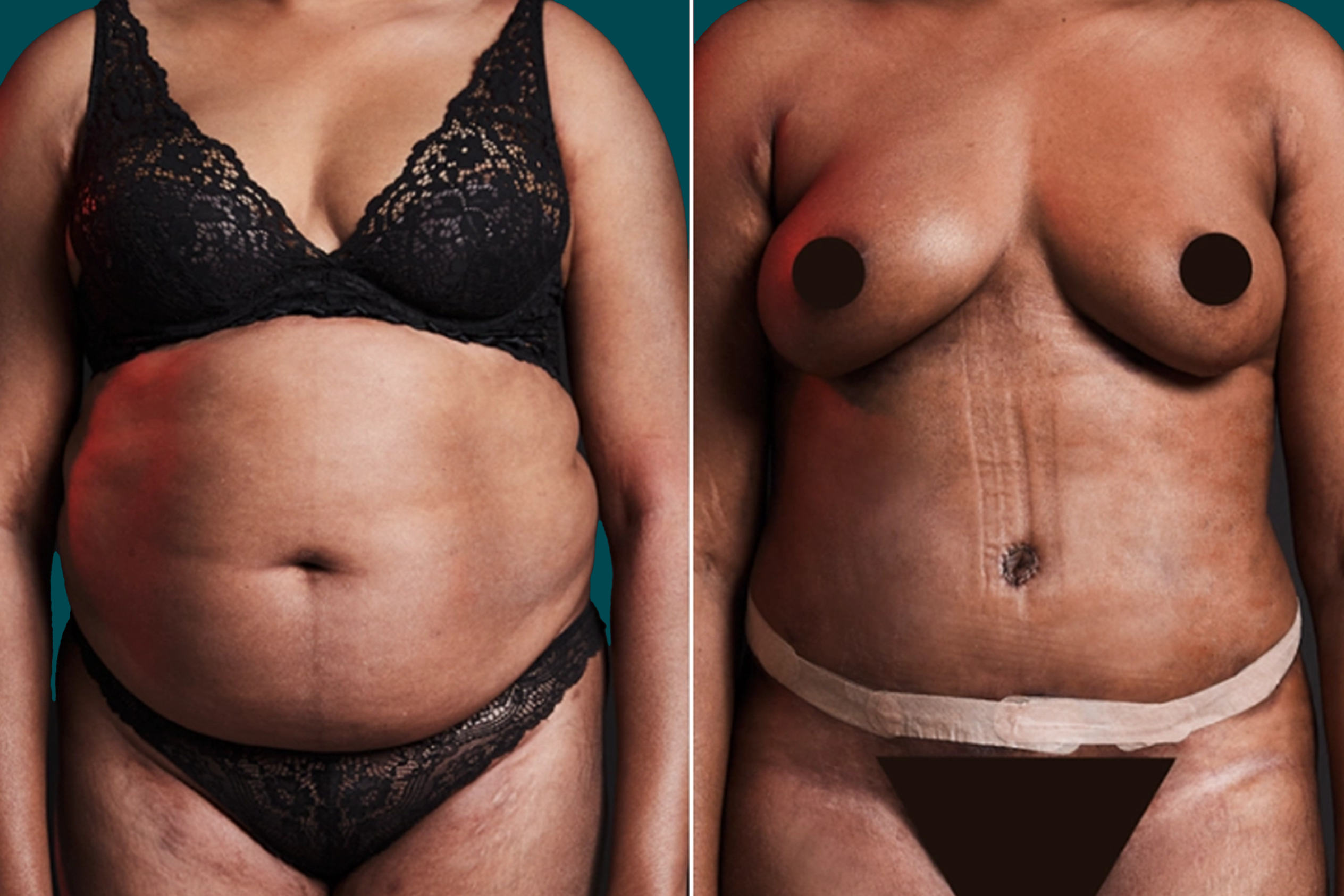 Liposuction Before and After 14