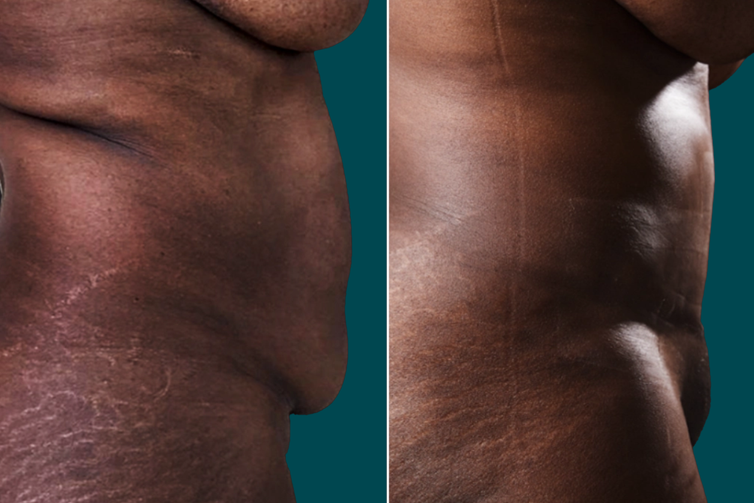 Liposuction Before and After 15