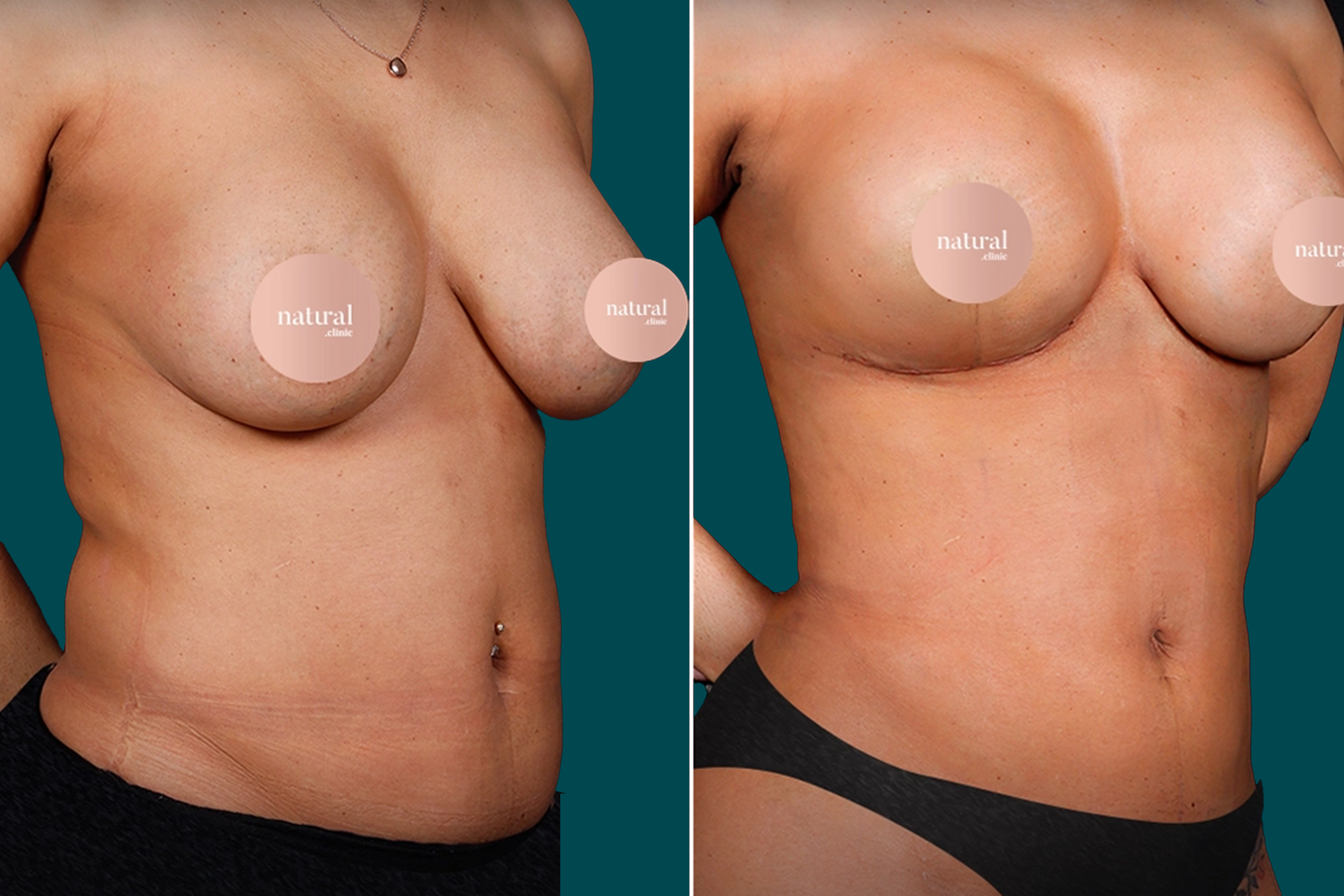 Liposuction Before and After 16