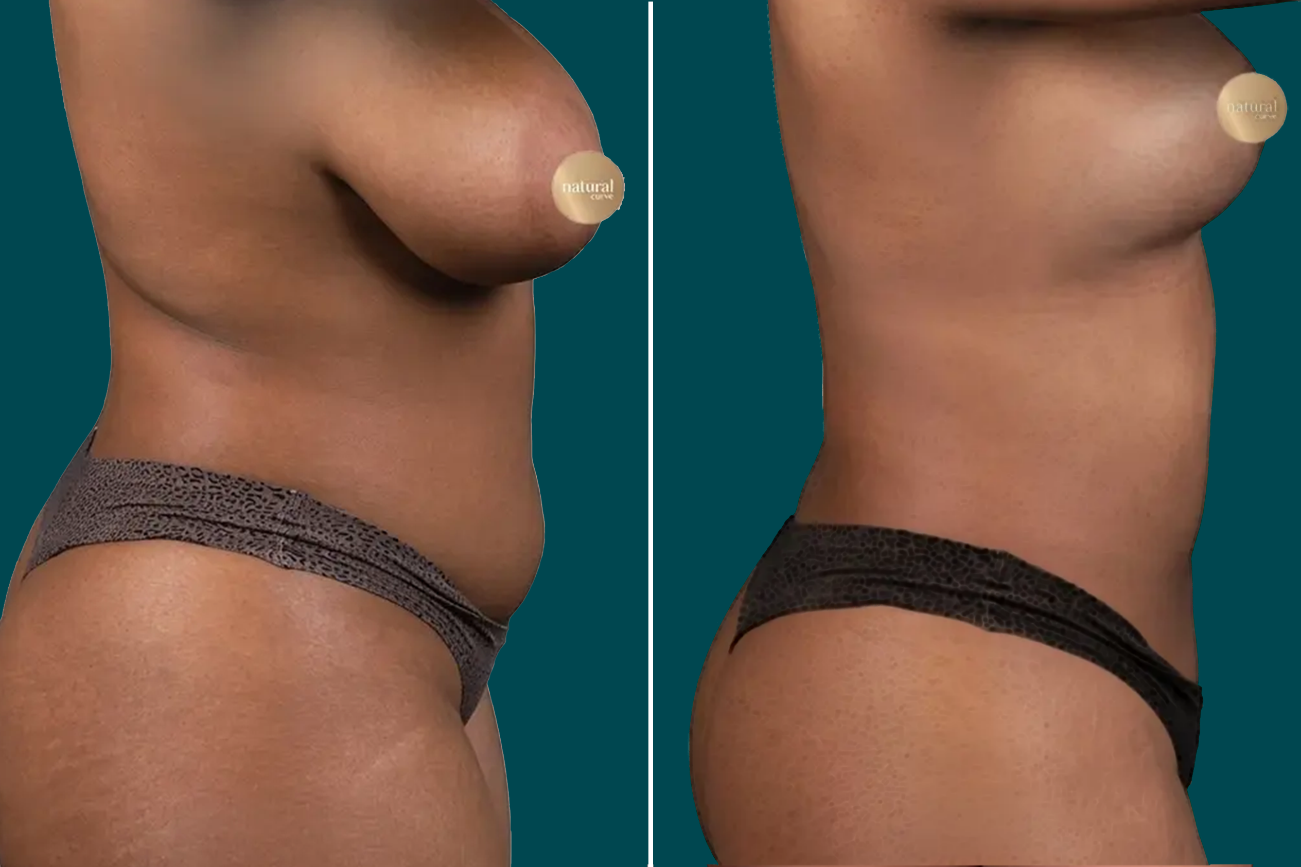 Liposuction Before and After 2