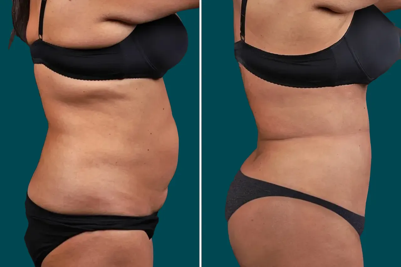 Liposuction Before and After 3