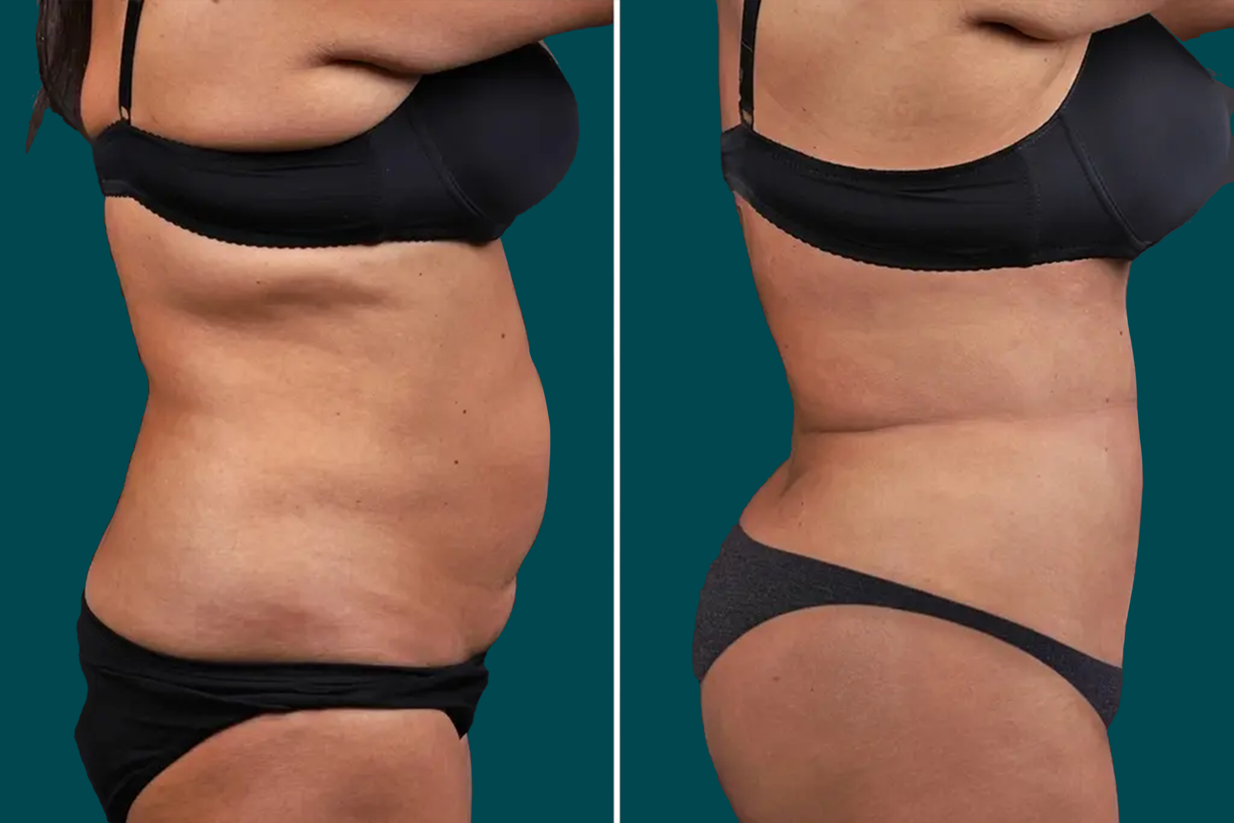 Liposuction Before and After 3