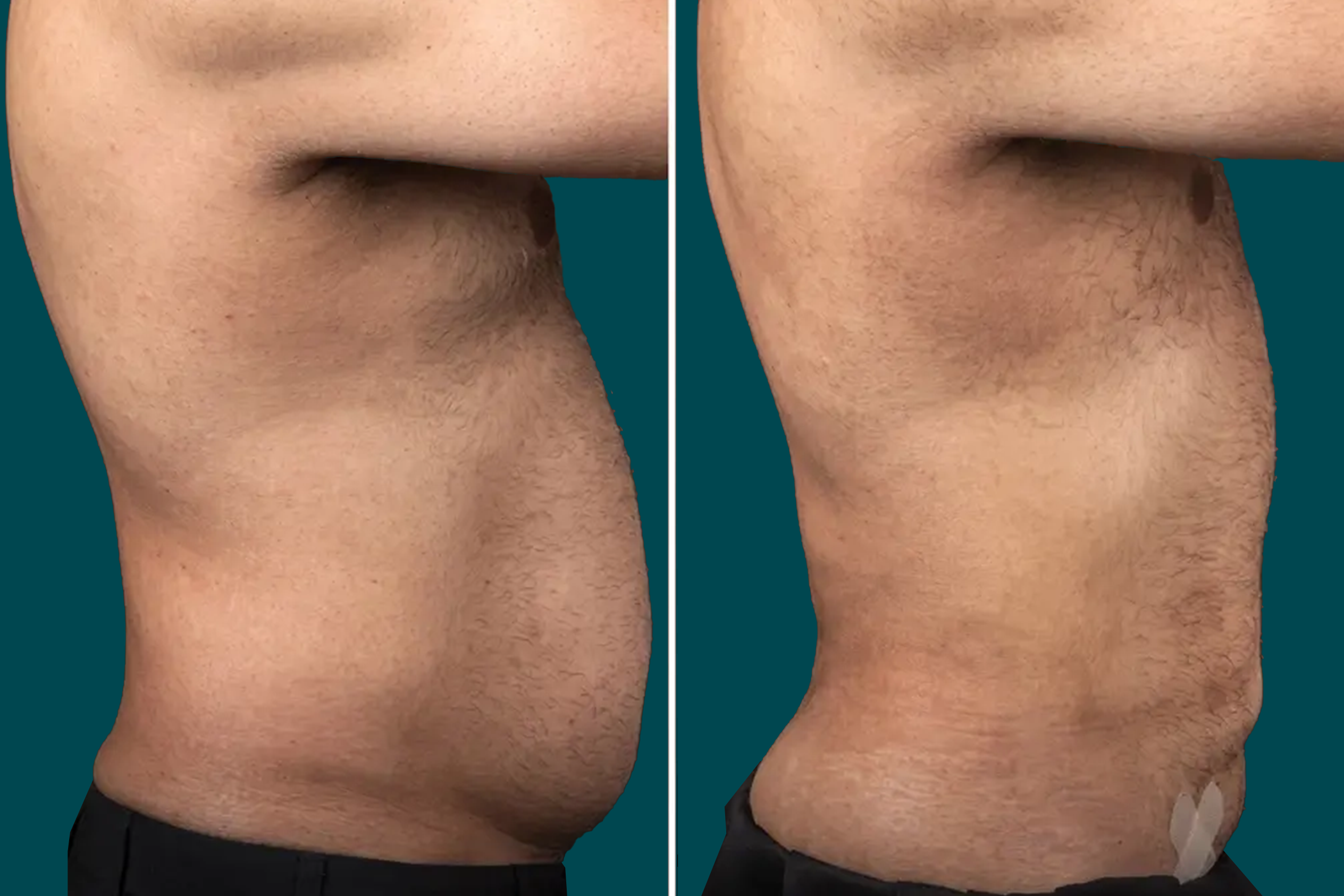Liposuction Before and After 4