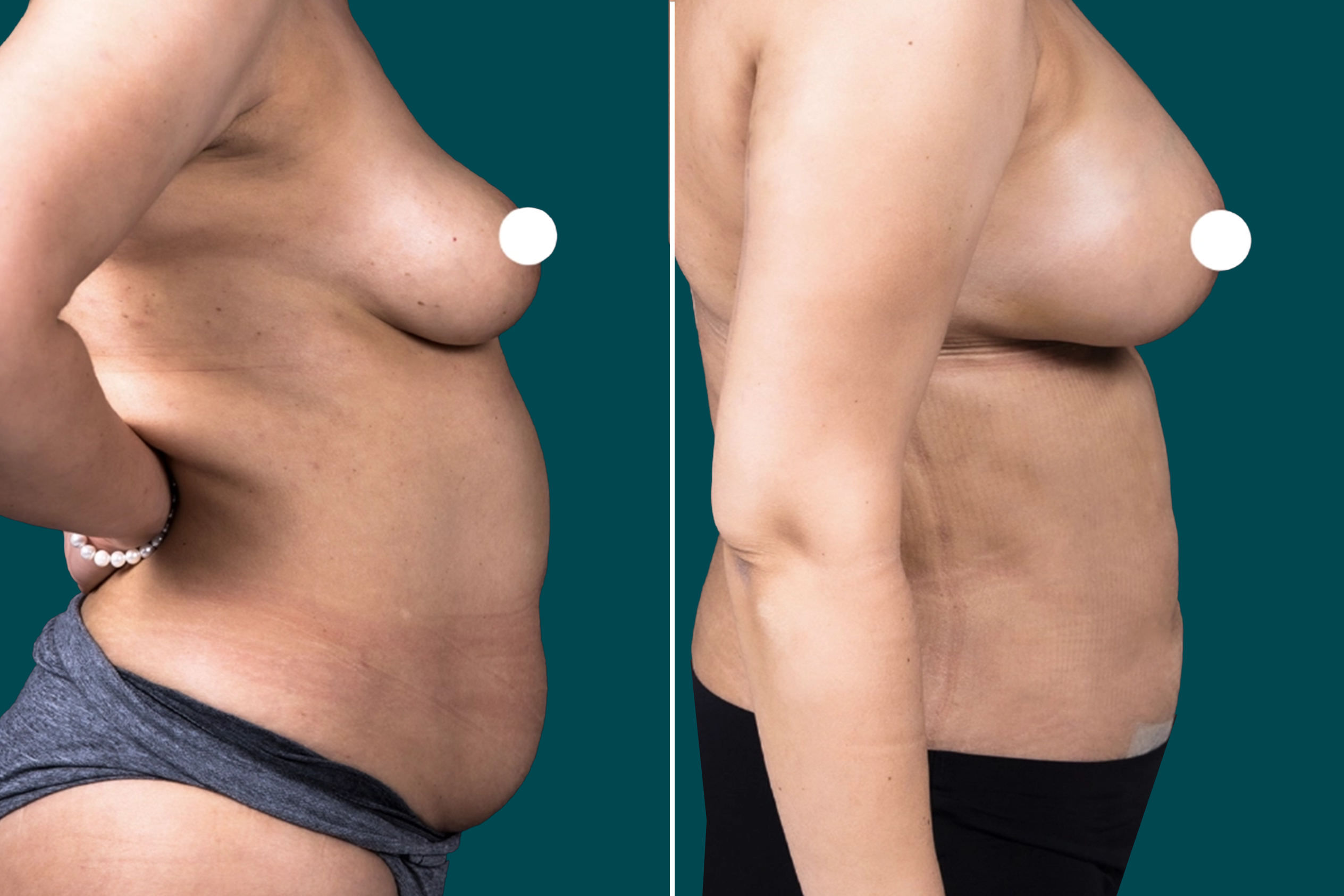 Liposuction Before and After 5