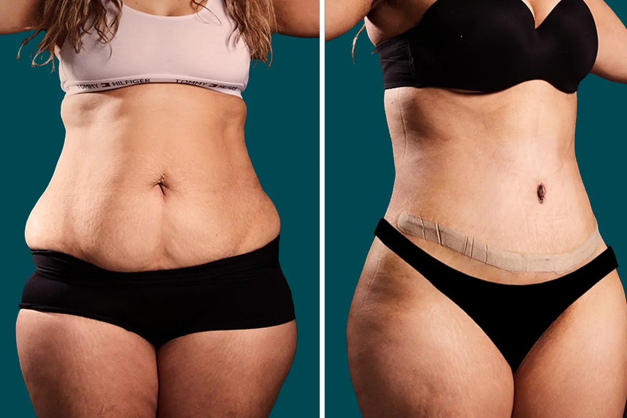 Liposuction Before and After 6
