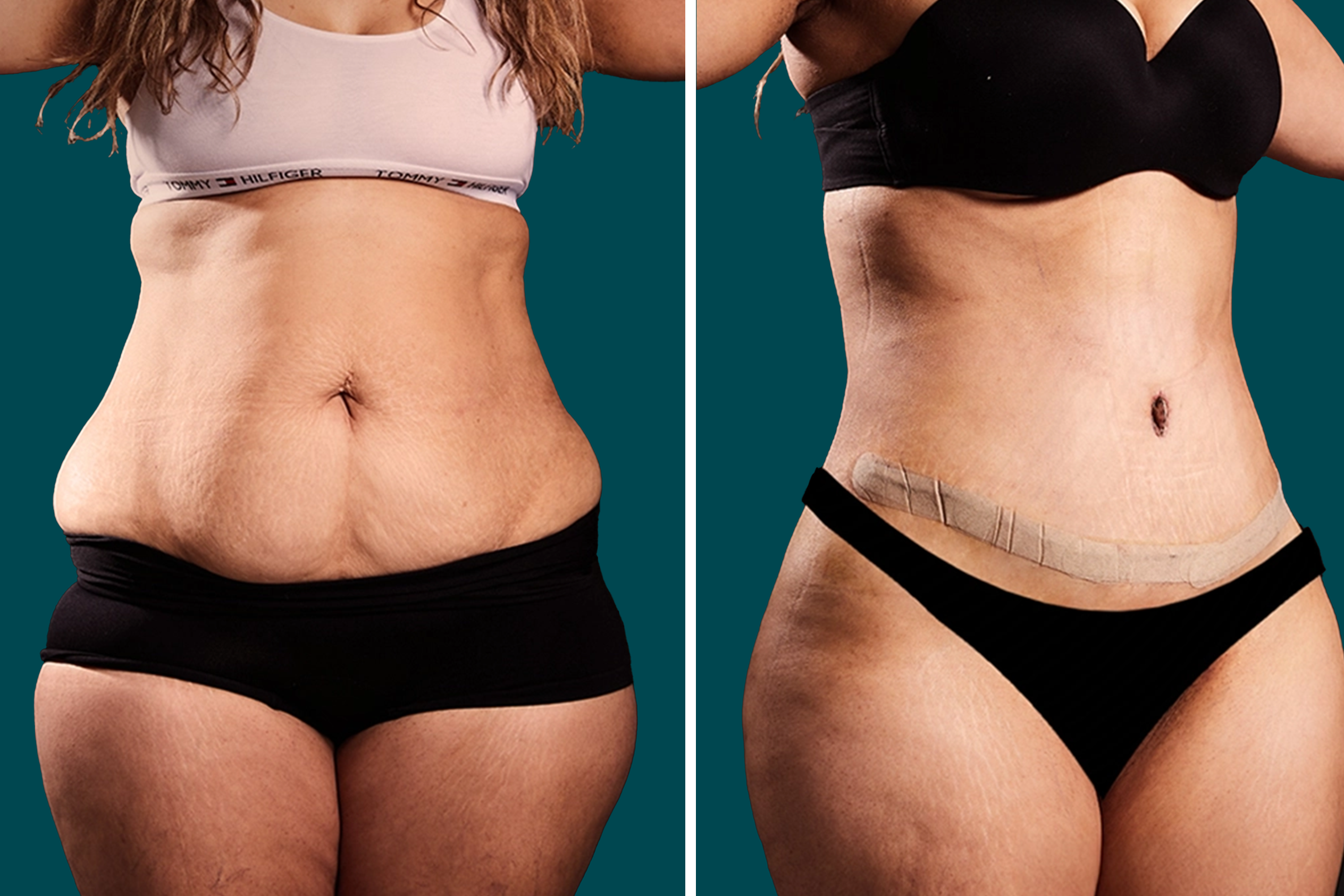 Liposuction Before and After 6
