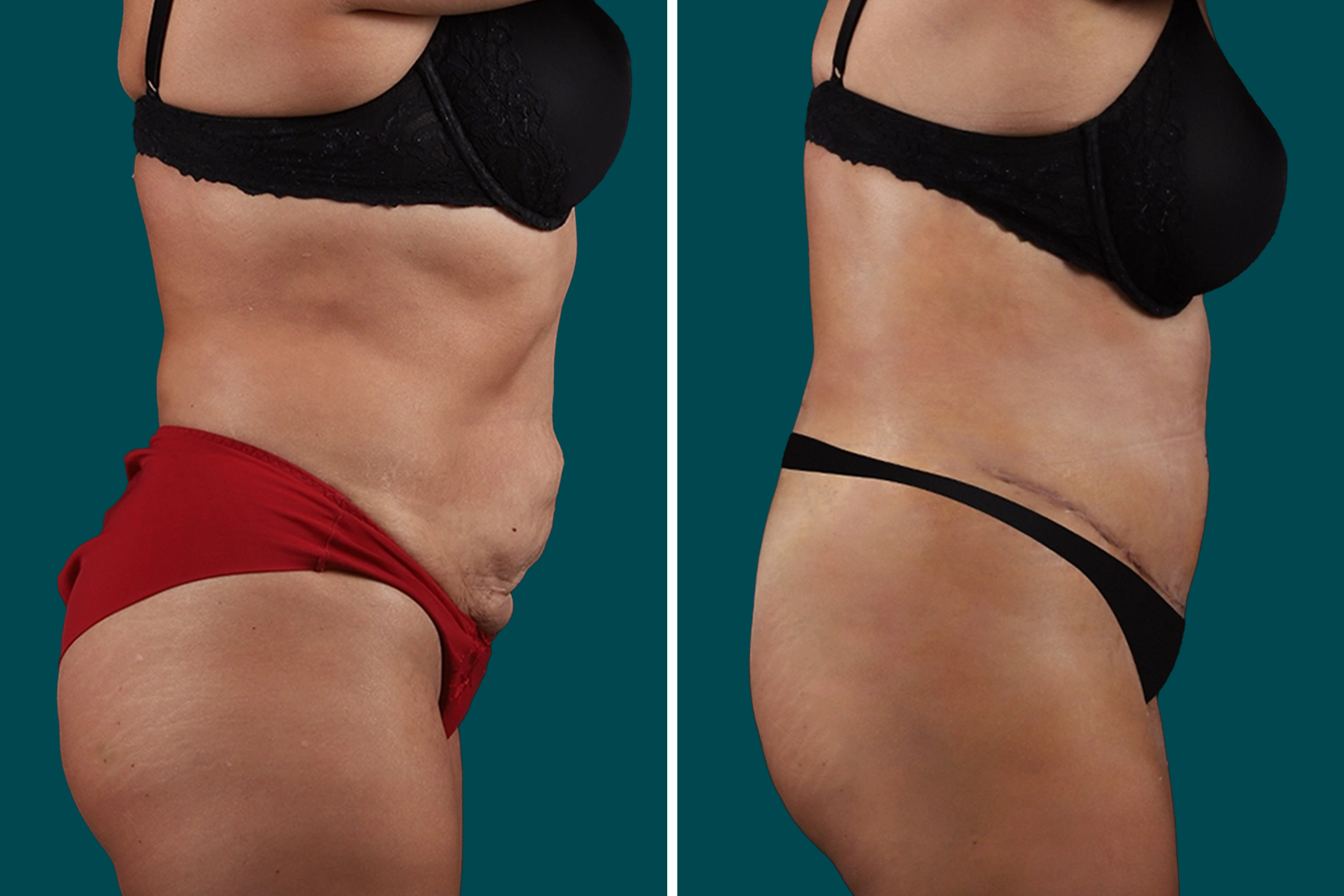 Liposuction Before and After 7