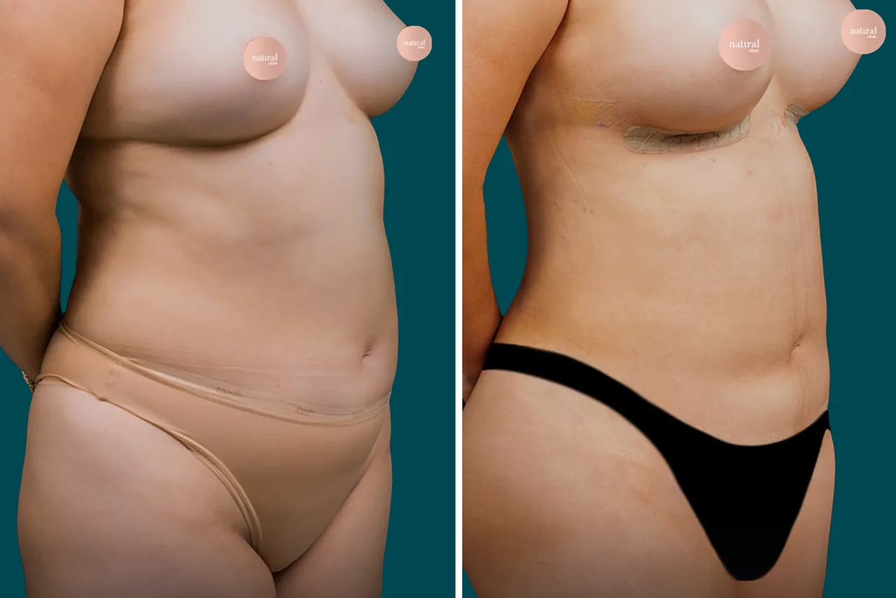 Liposuction Before and After 8