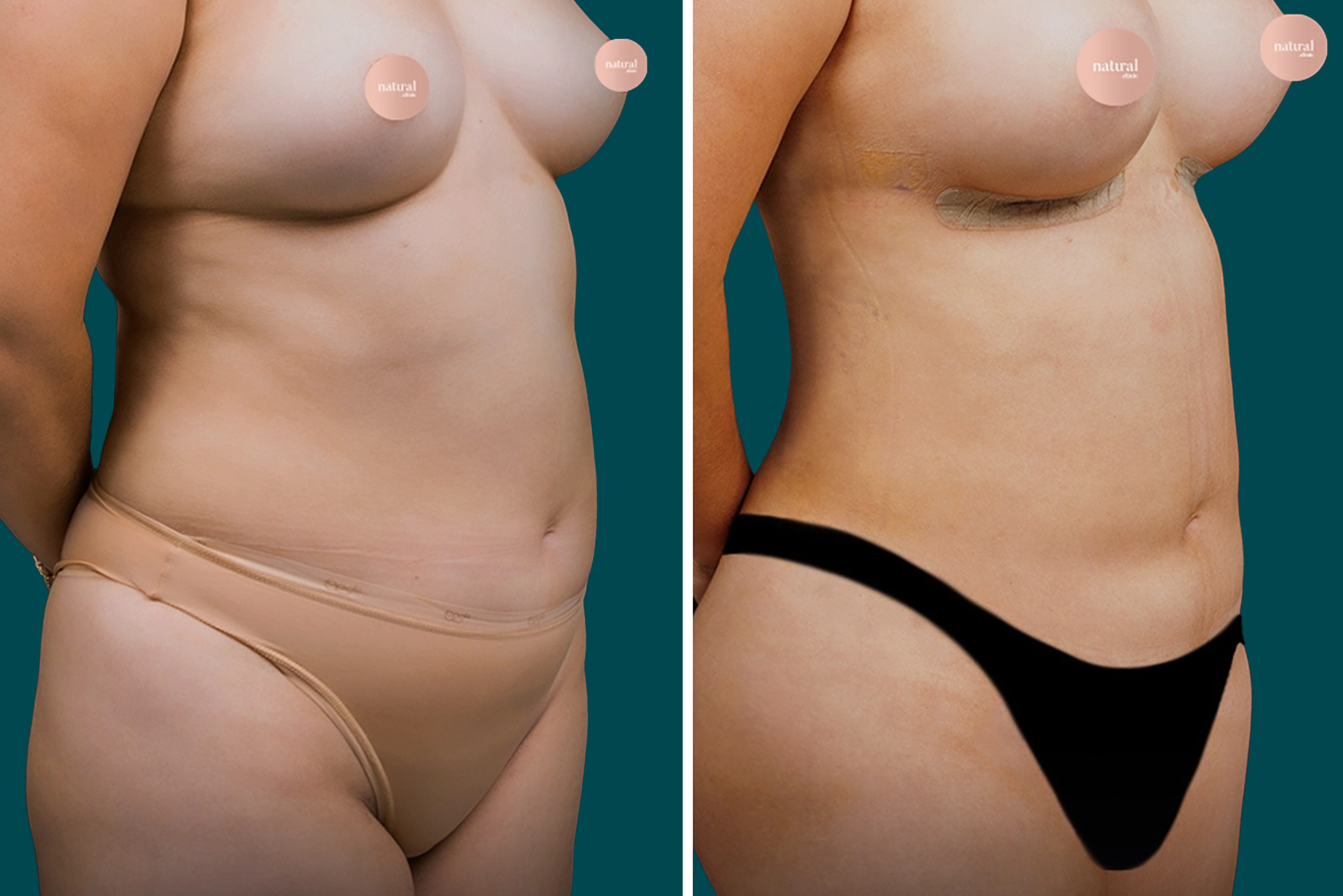 Liposuction Before and After 8