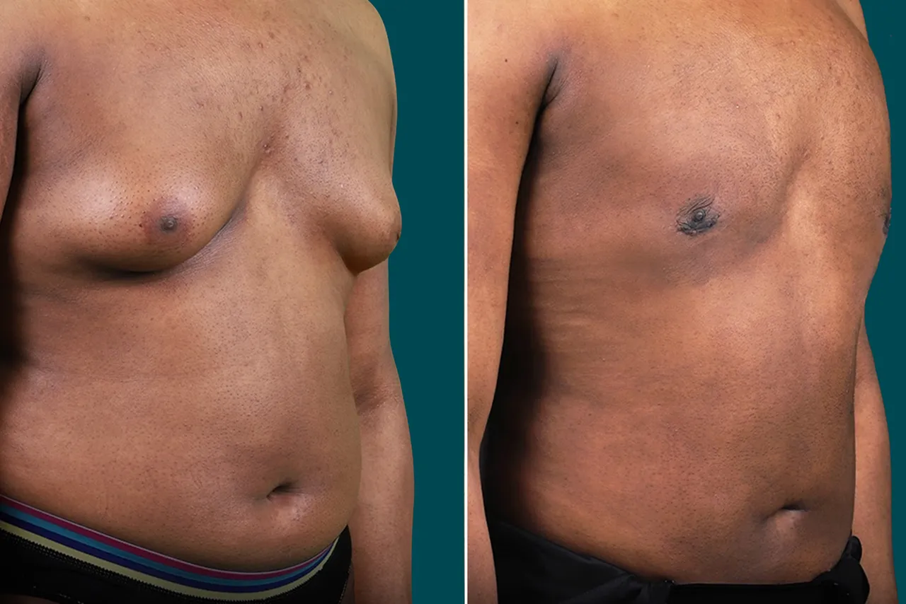 Liposuction Before and After 9