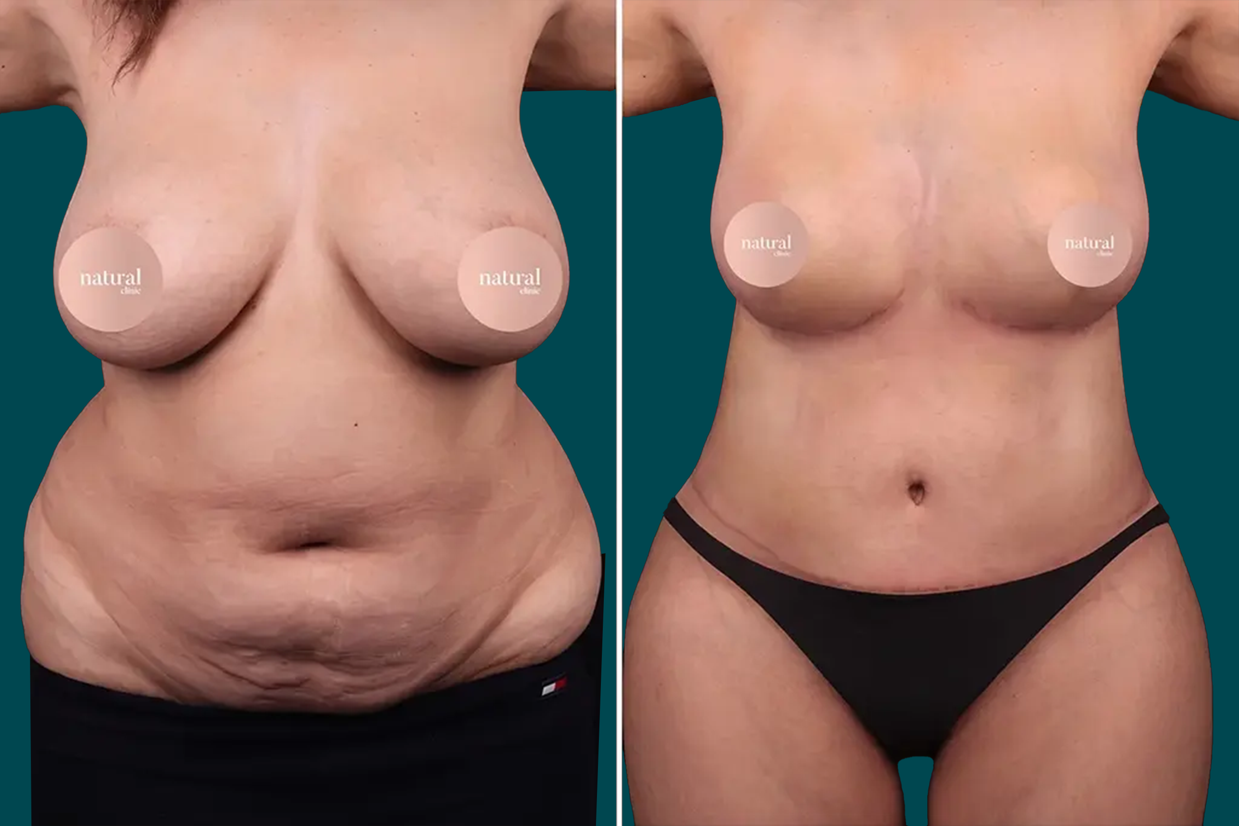 Mommy Makeover Before and After 1