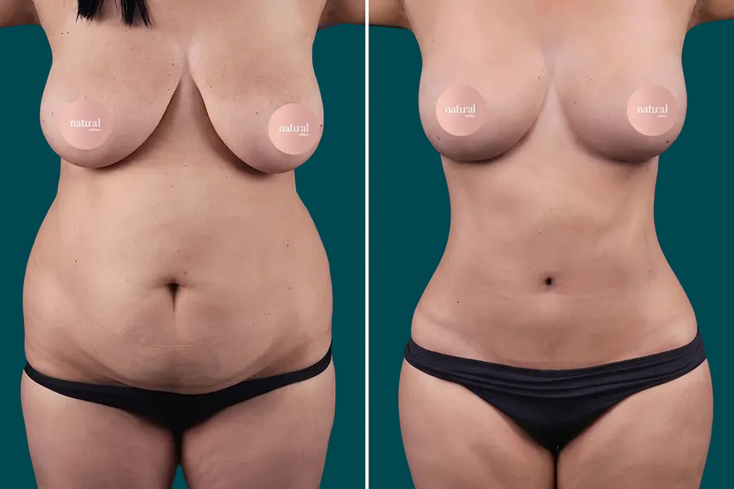 Mommy Makeover Before and After 2