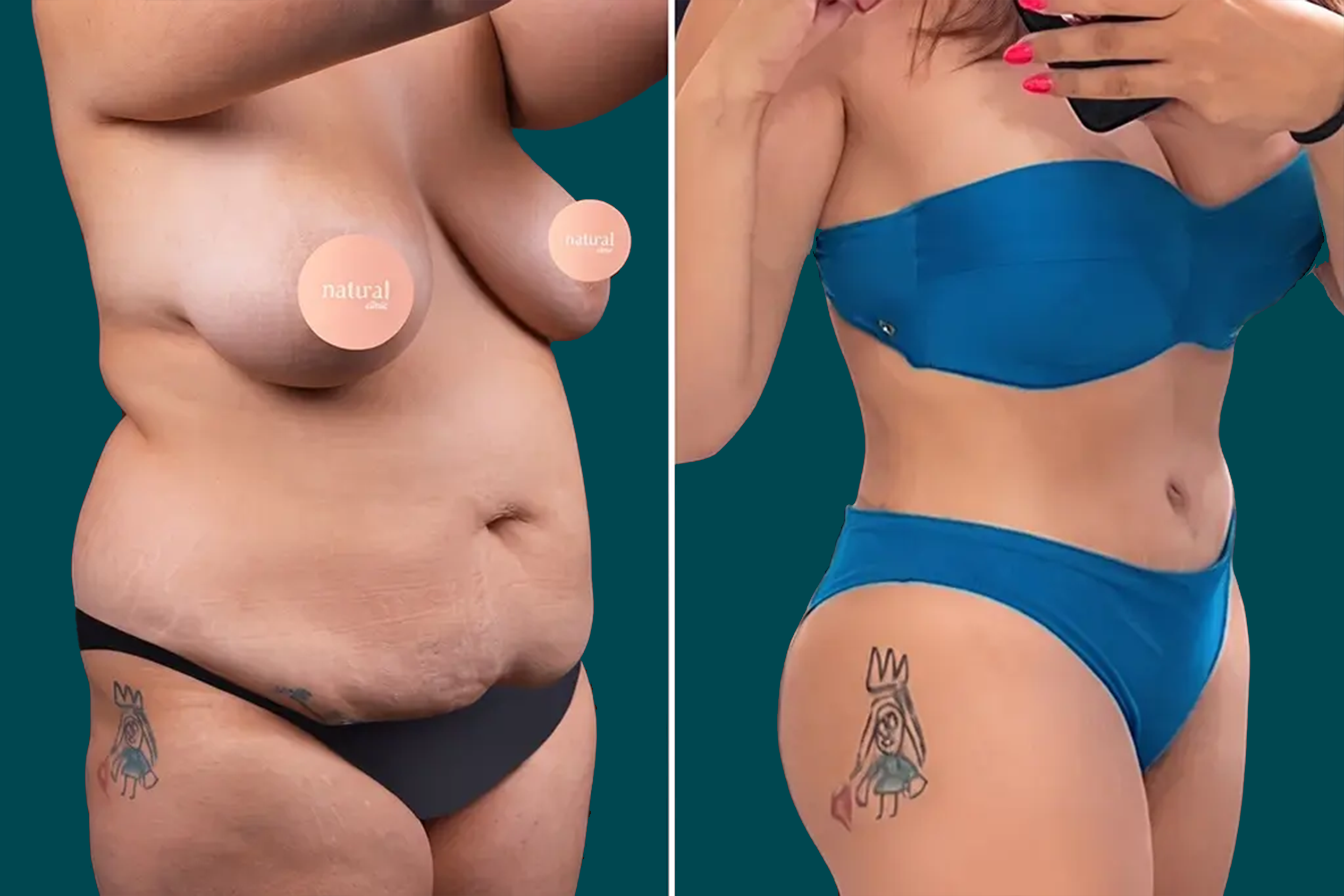 Mommy Makeover Before and After 3