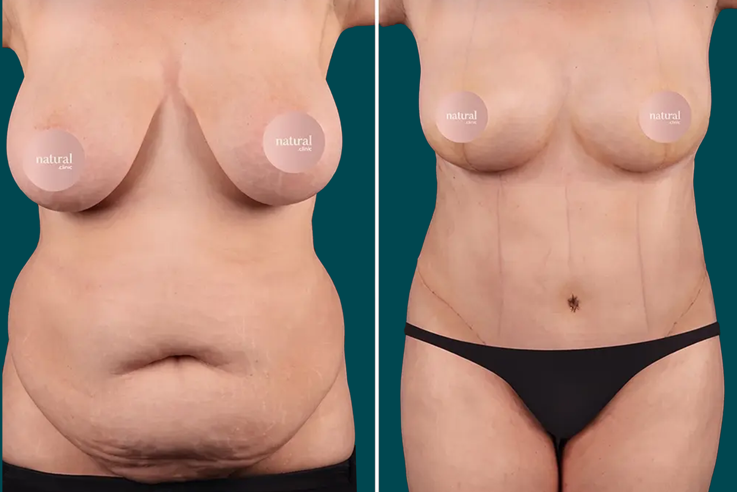 Mommy Makeover Before and After 4