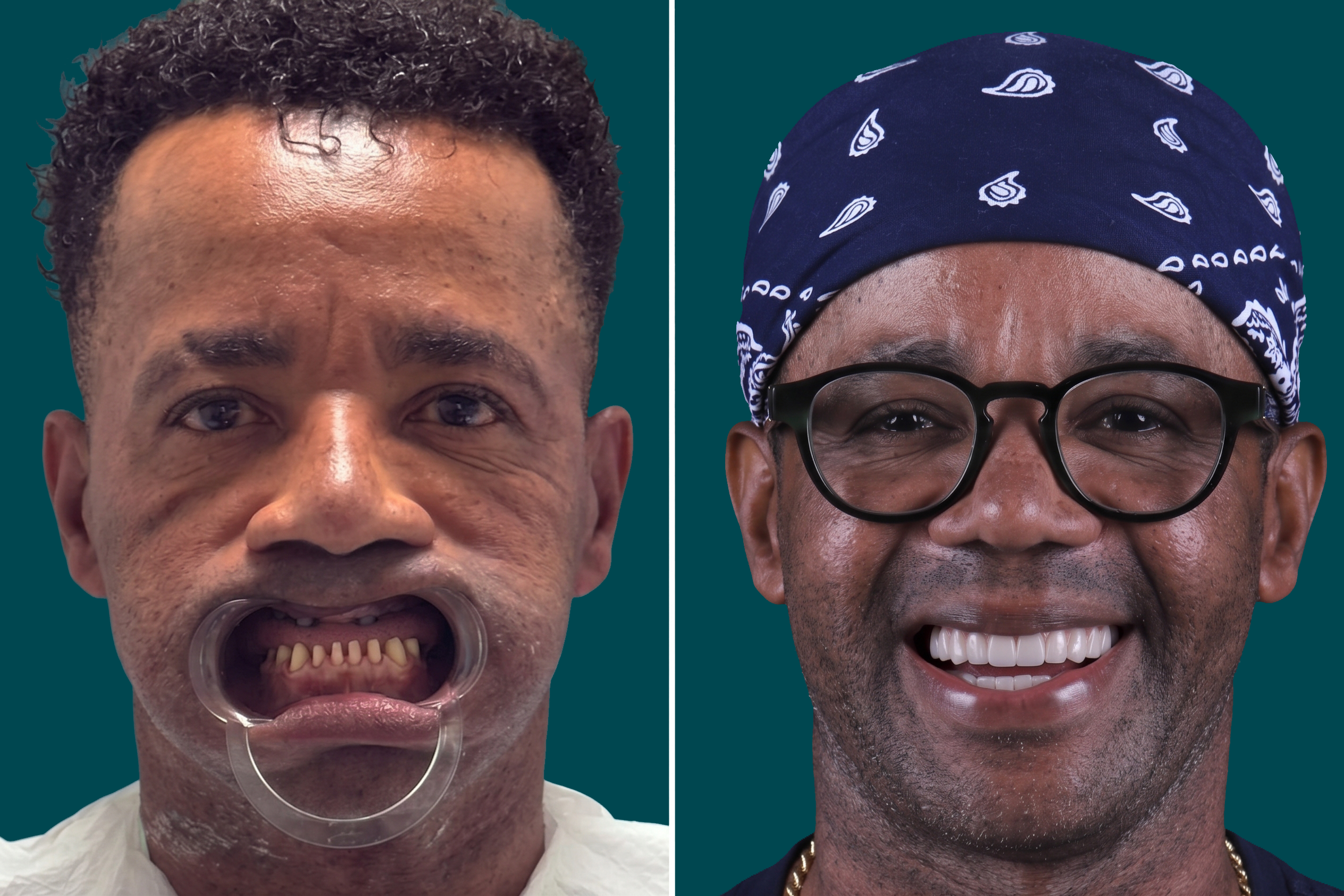 Dental Implants- Multiple Dental Implants (1)