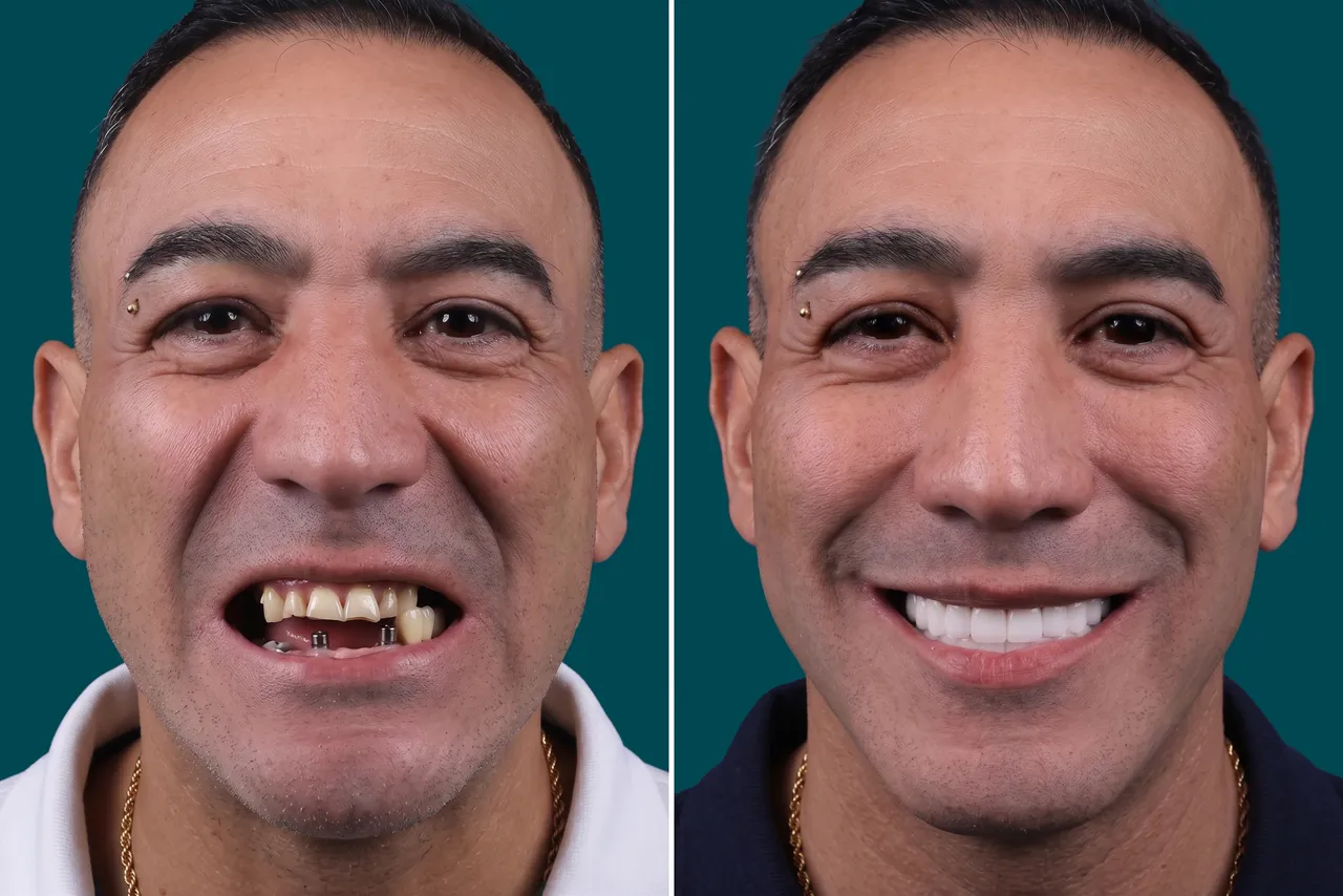 Dental Implants-Multiple Dental Implants 4
