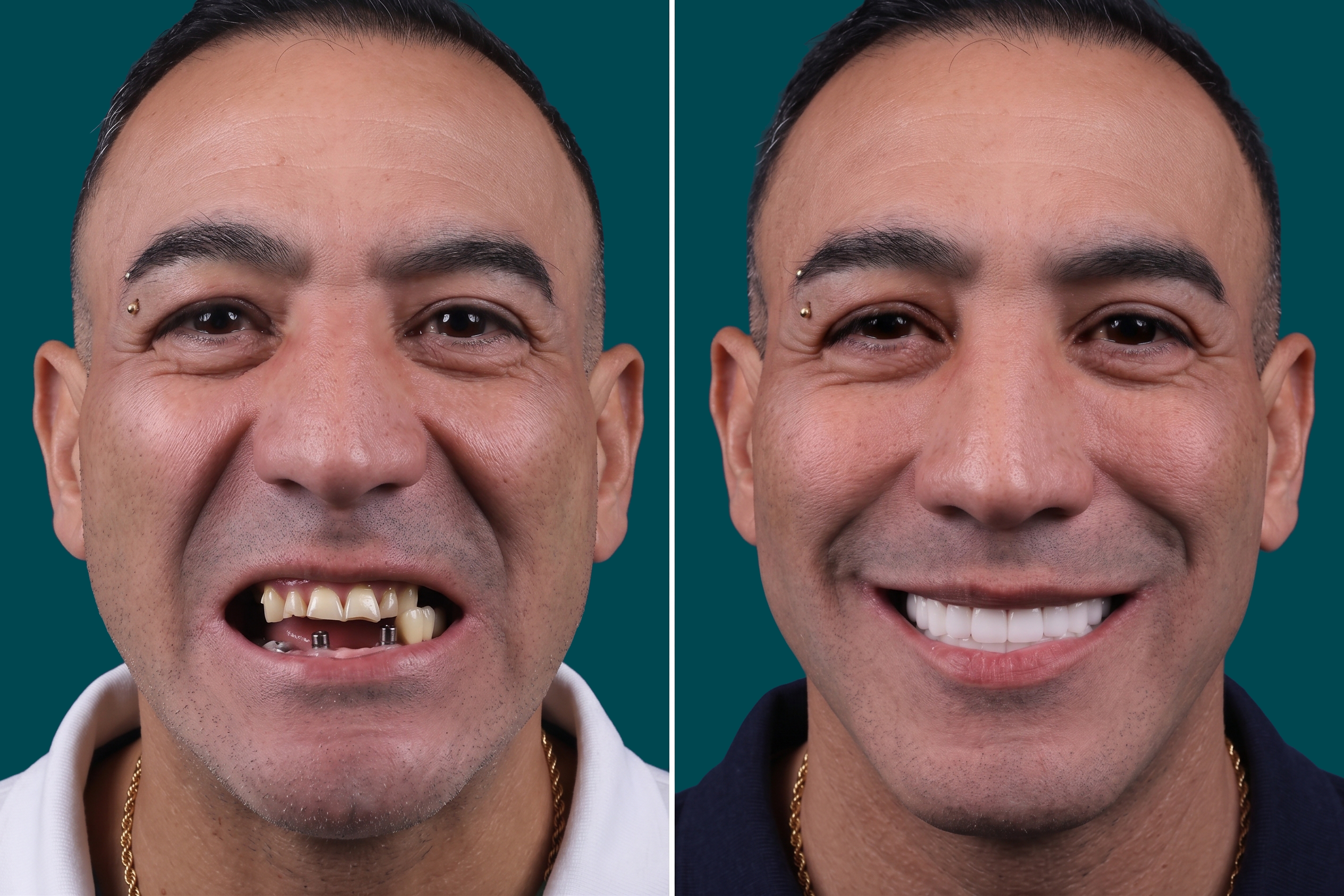 Dental Implants-Multiple Dental Implants 4