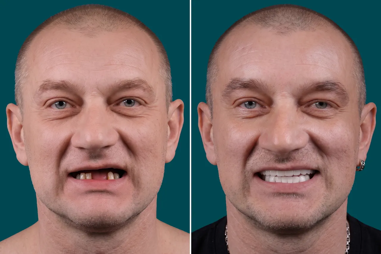 Dental Implants-Multiple Dental Implants 2
