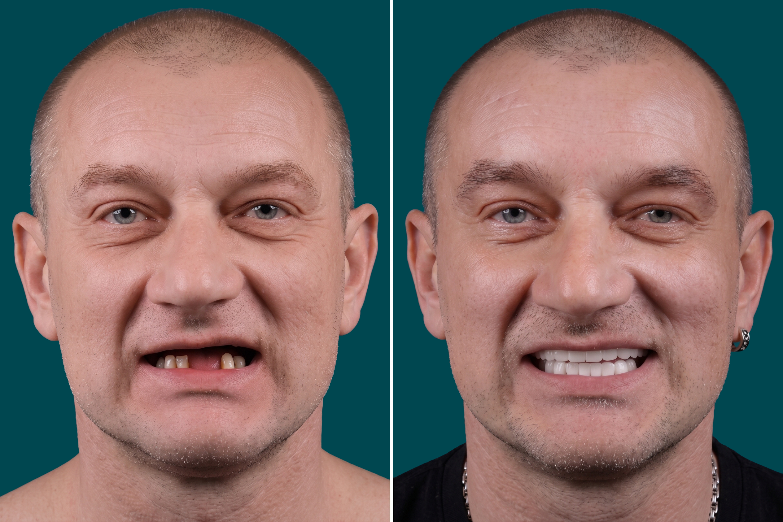Dental Implants-Multiple Dental Implants 2