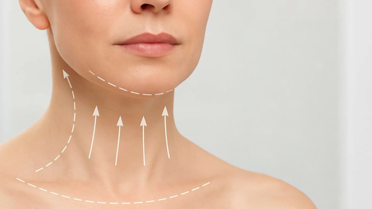 Neck Lift