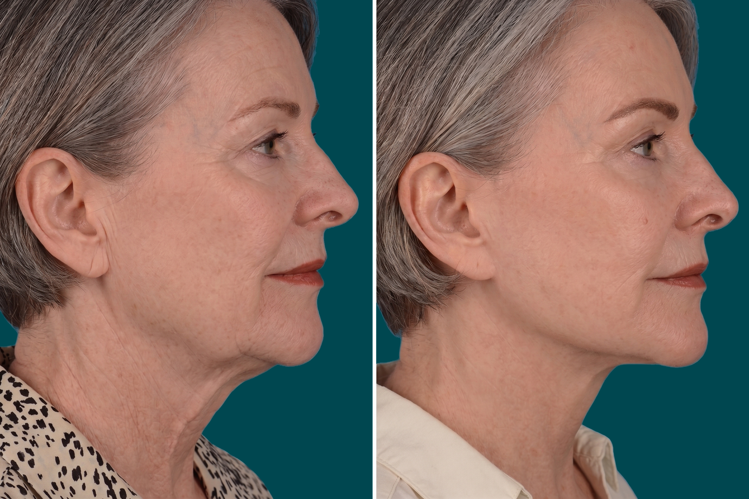 Neck Lift Before and After 1